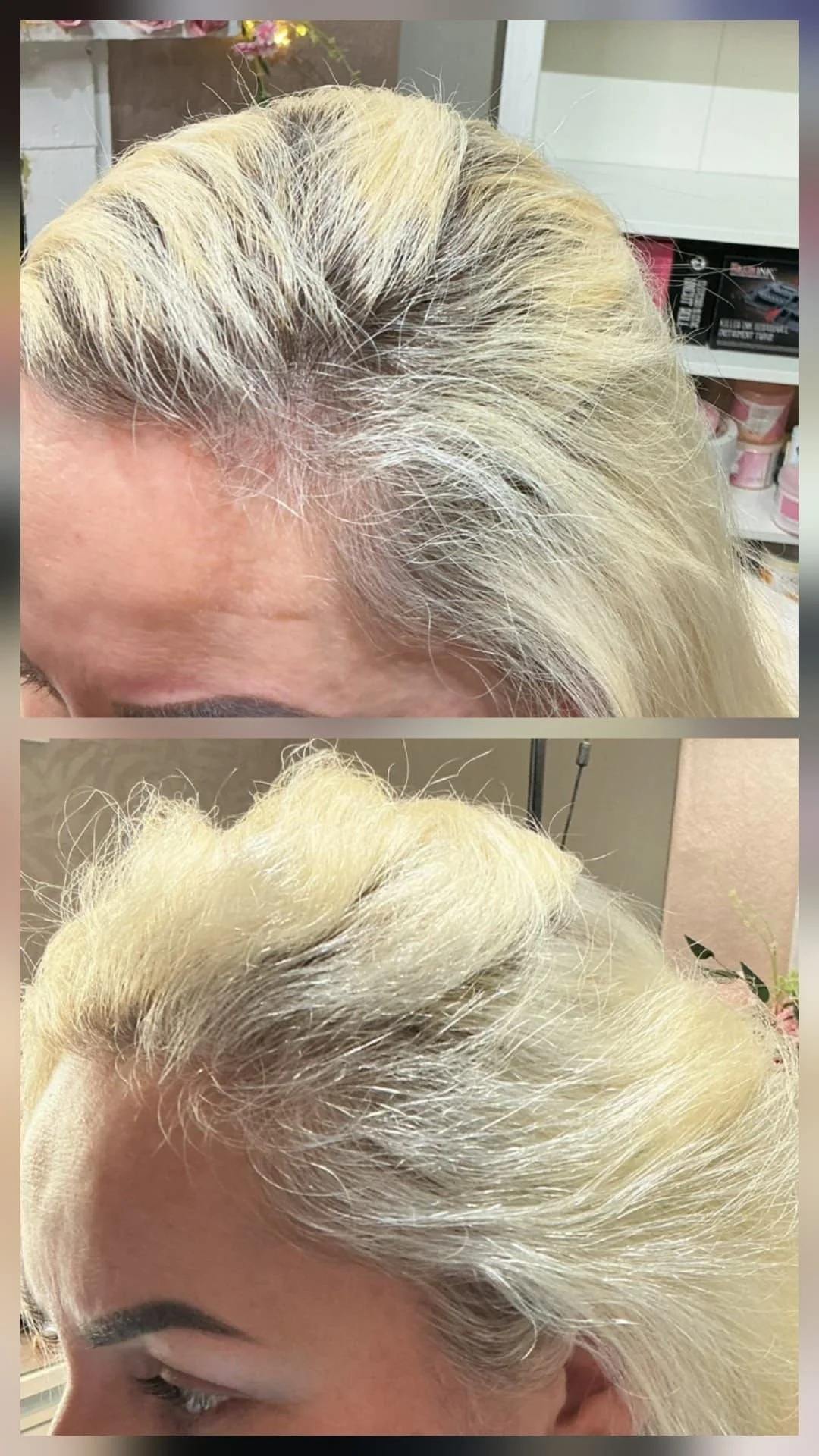Hair Filler & Microneedling results after 1 month (before) and 3 months (after).