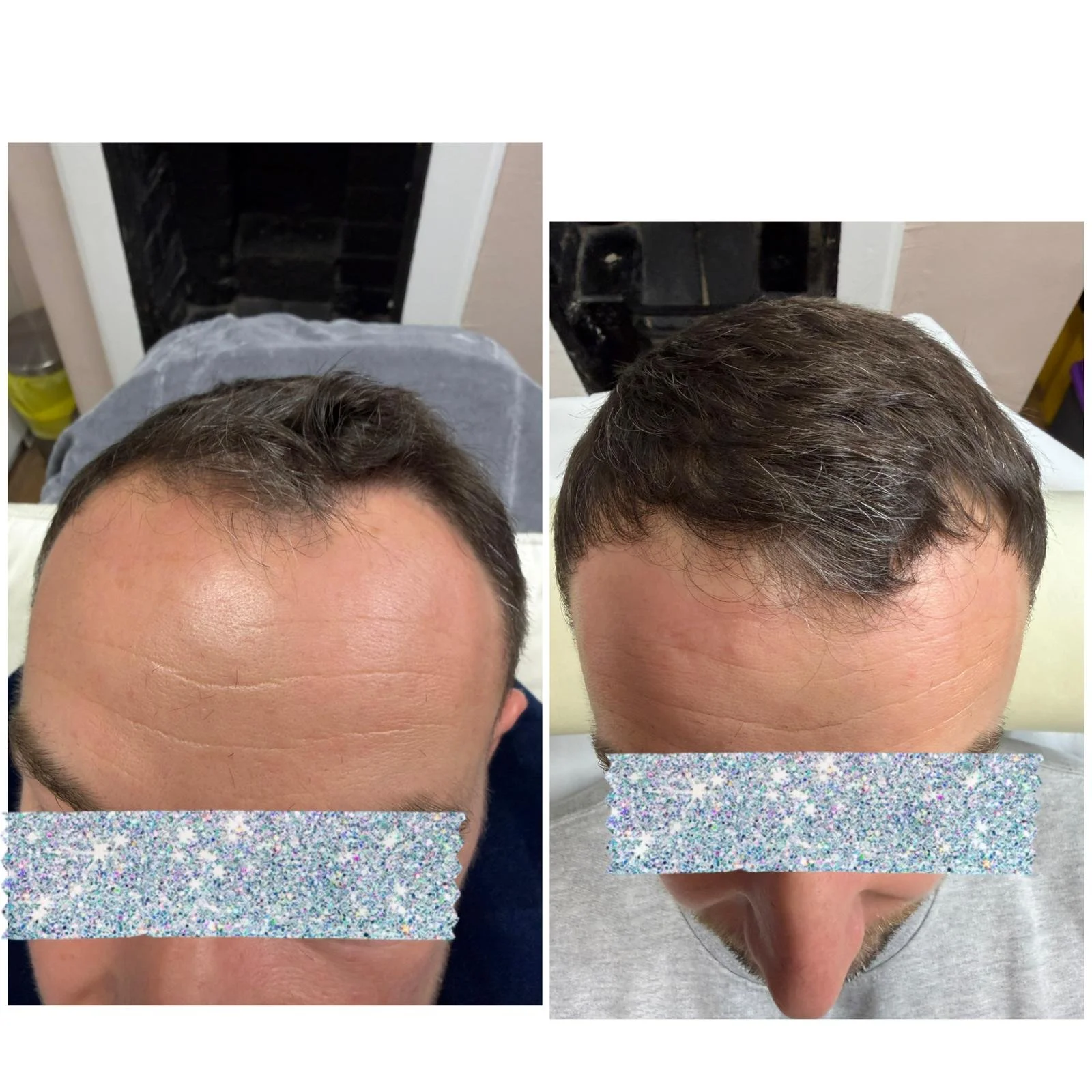 Advanced Hair Filler and microneedling, 4 months later