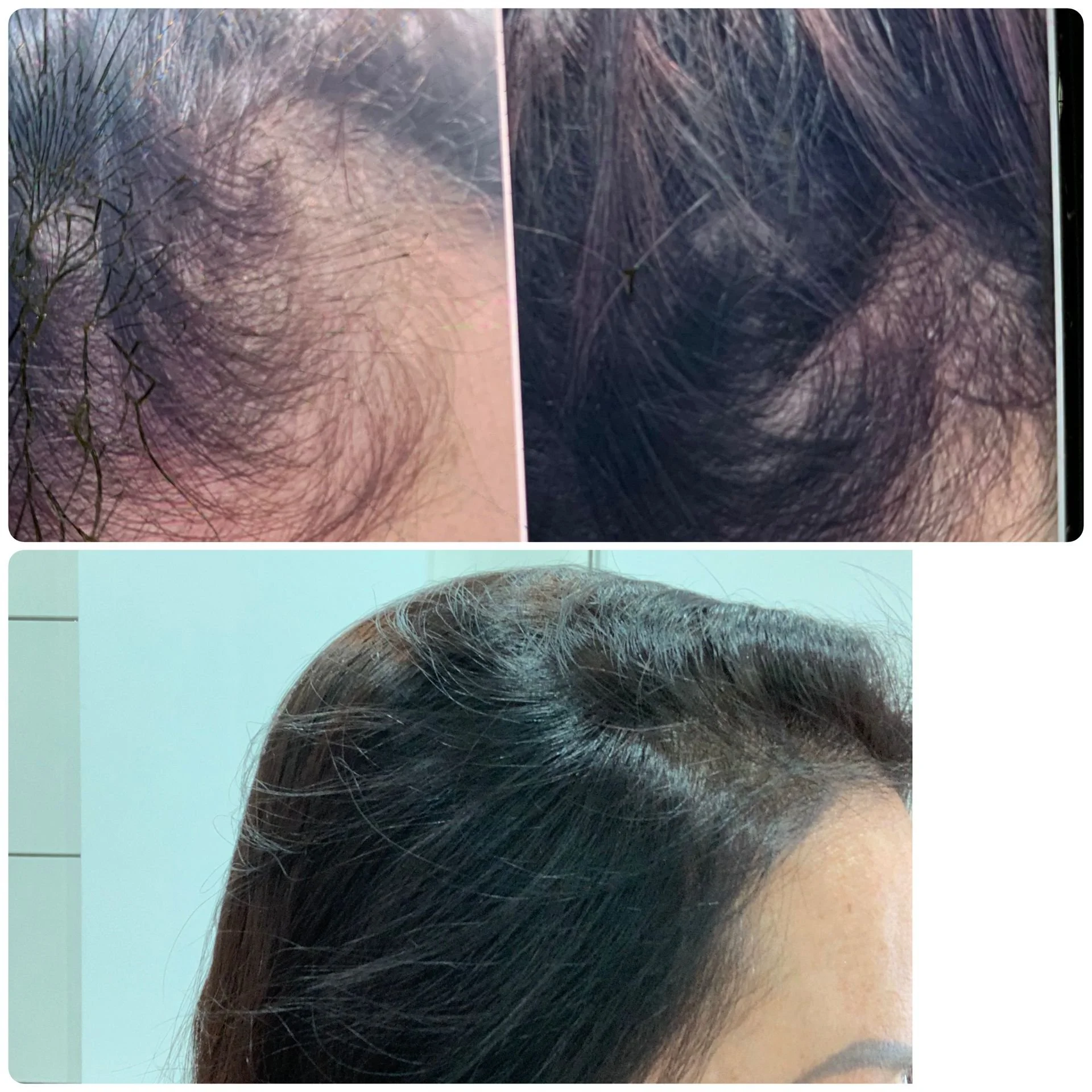 Microneedling Before & After
Results After 6 Sessions