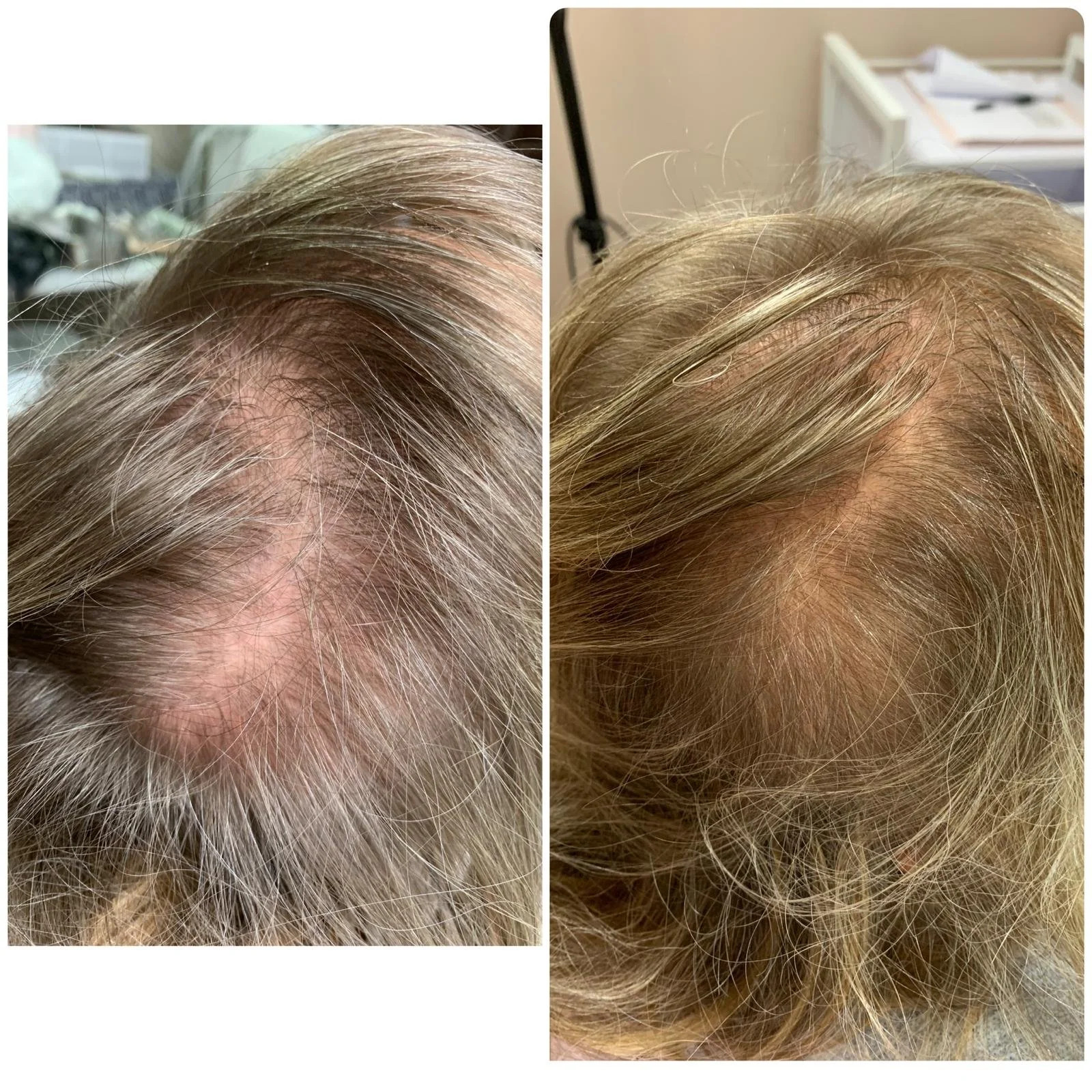 Hair Filler & Microneedling results after 1 month (before) and 3 months (after).