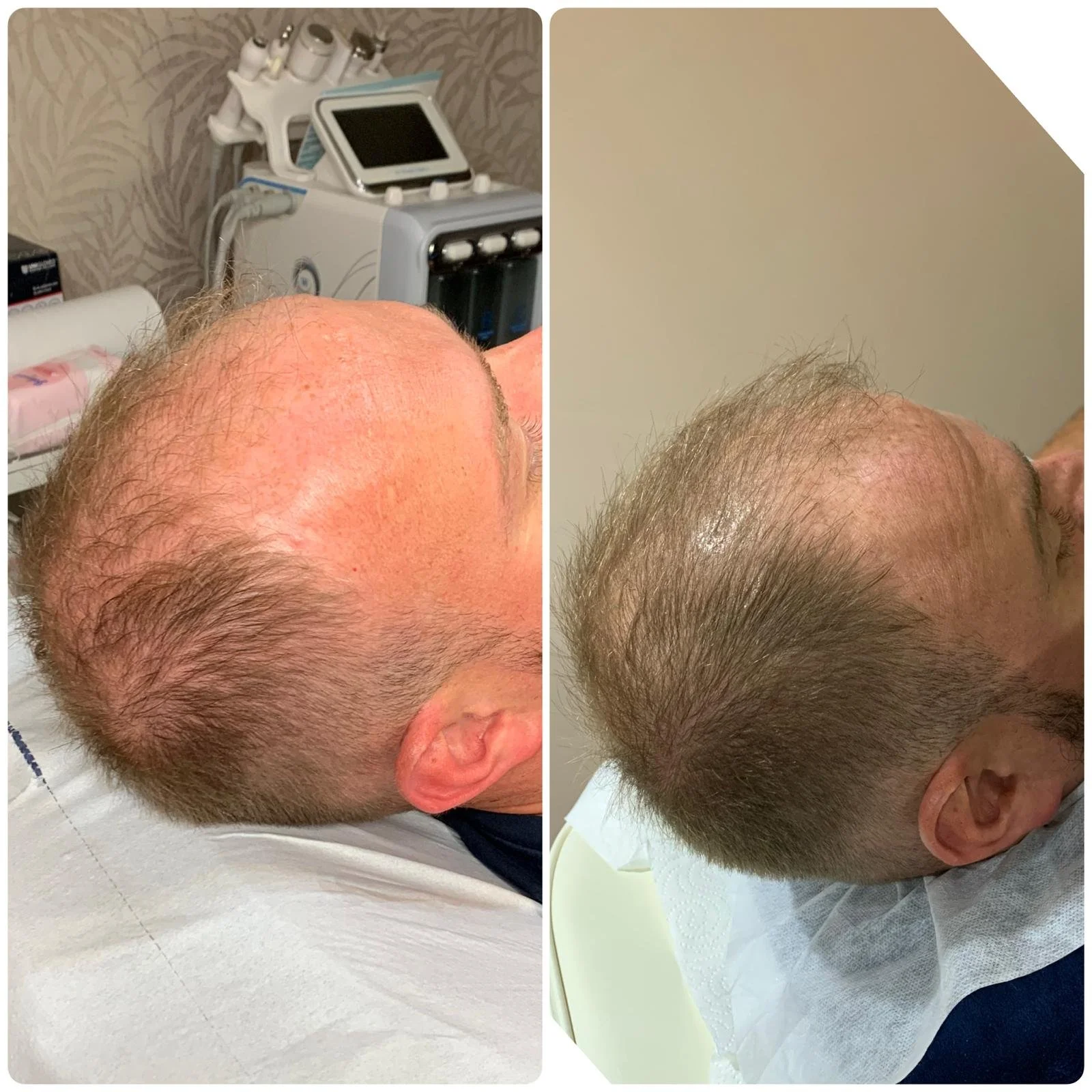 Hair Filler & Microneedling results after 1 month (before) and 3 months (after).