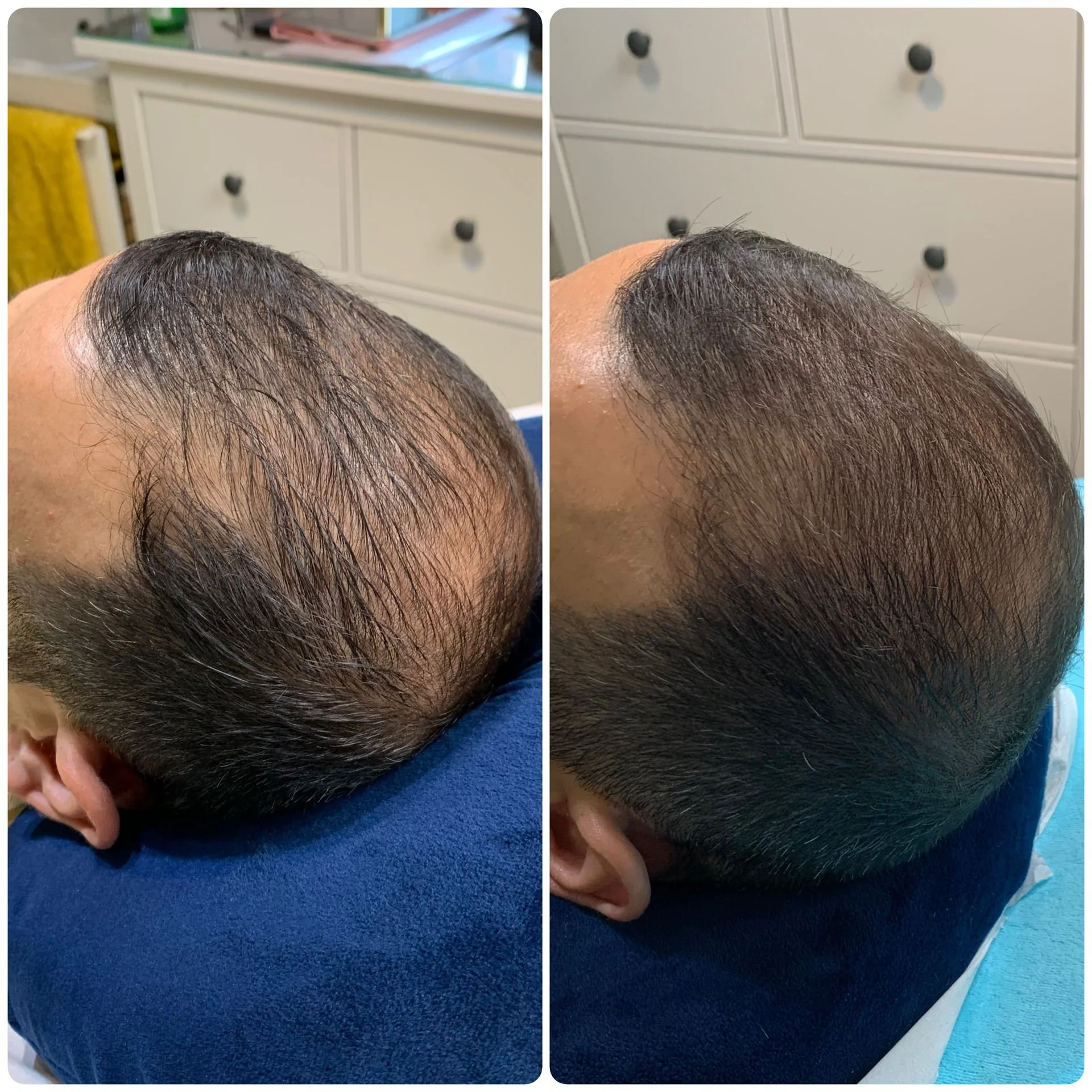 Hair Filler & Microneedling results after 1 month (before) and 3 months (after).