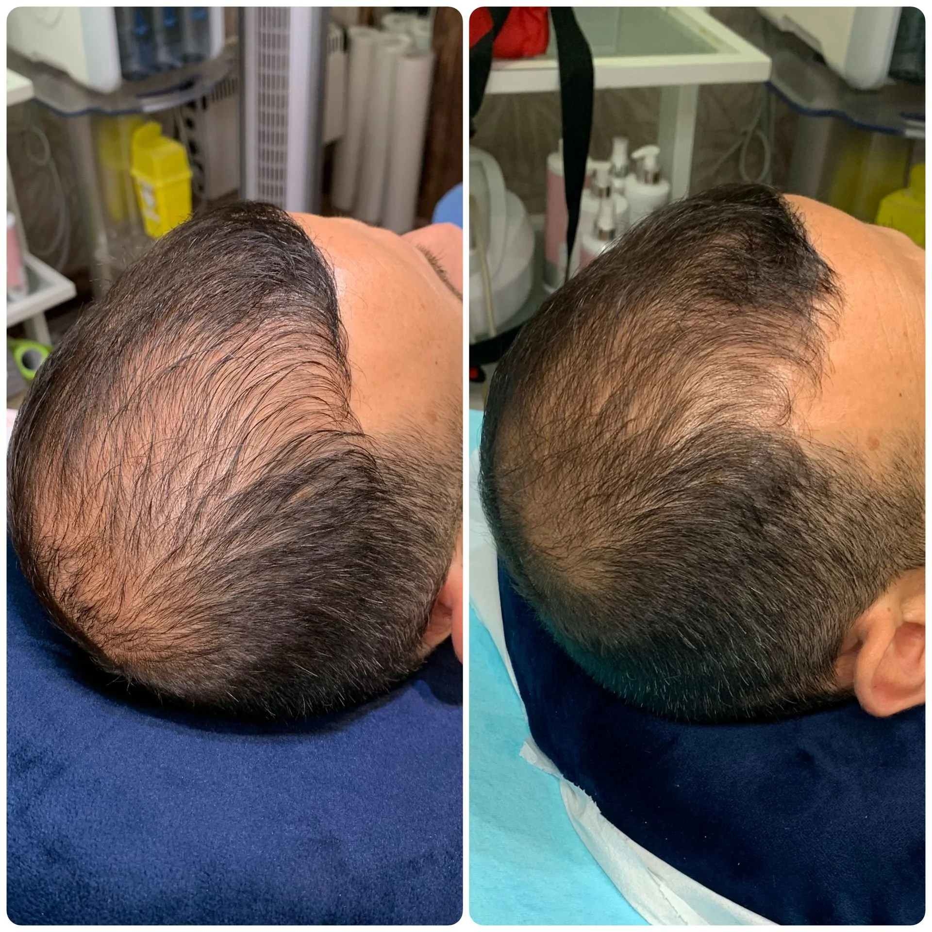Hair Filler & Microneedling results after 1 month (before) and 3 months (after).