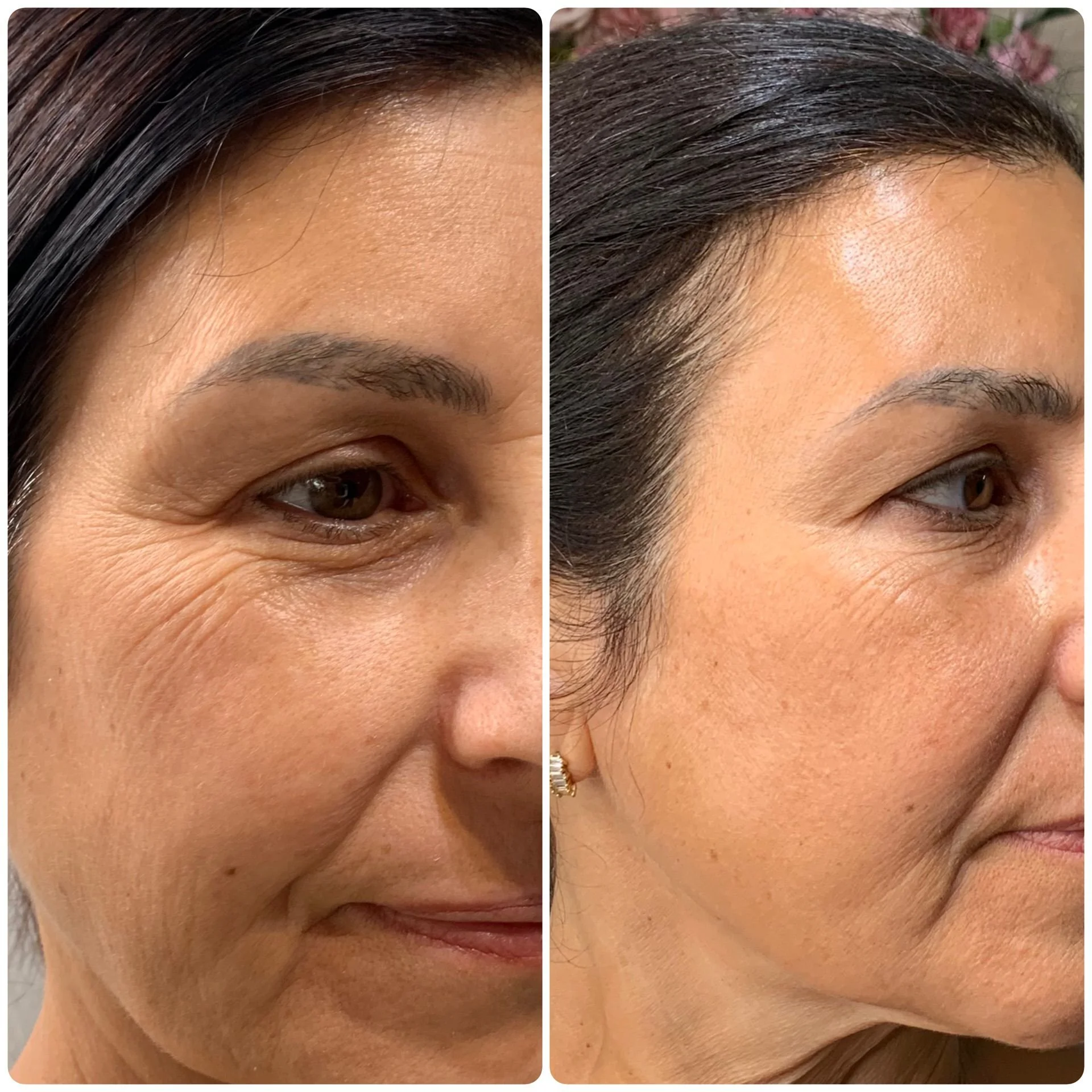 Facial PRP results before and after 2 sessions.