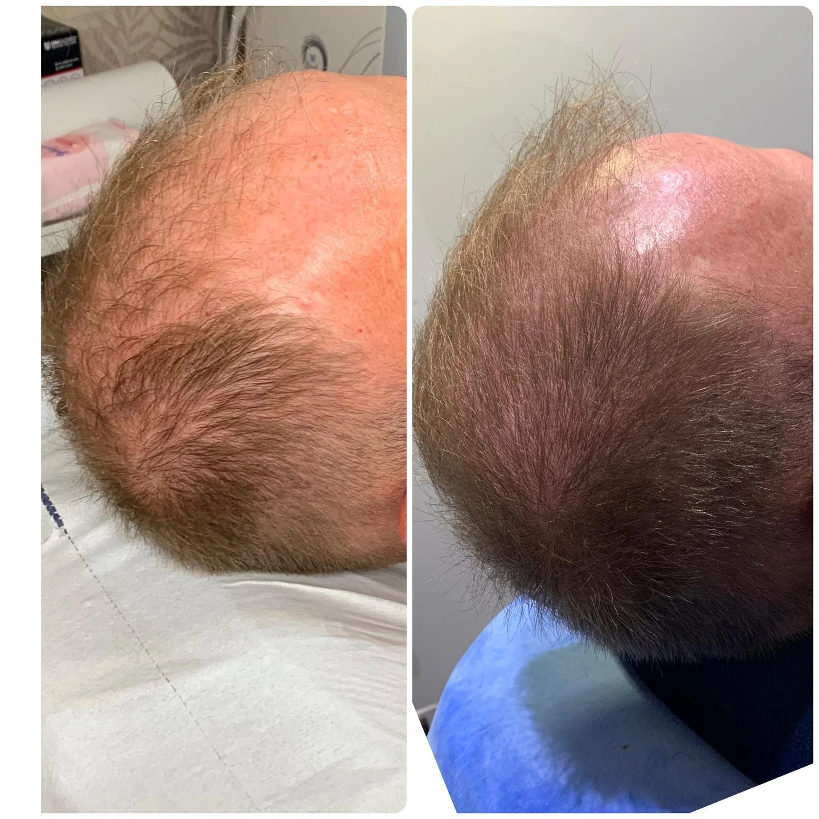 Hair Filler & Microneedling results after 1 month (before) and 3 months (after).