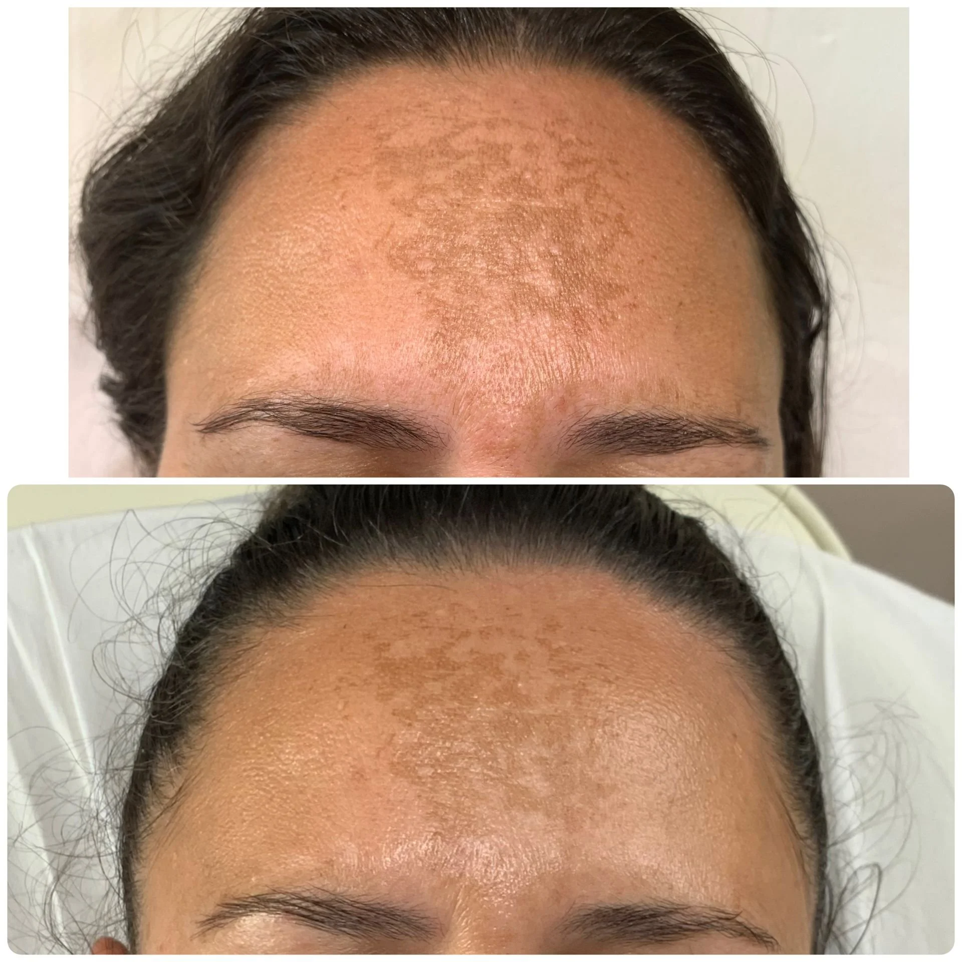 Facial PRP results before and after 2 sessions.