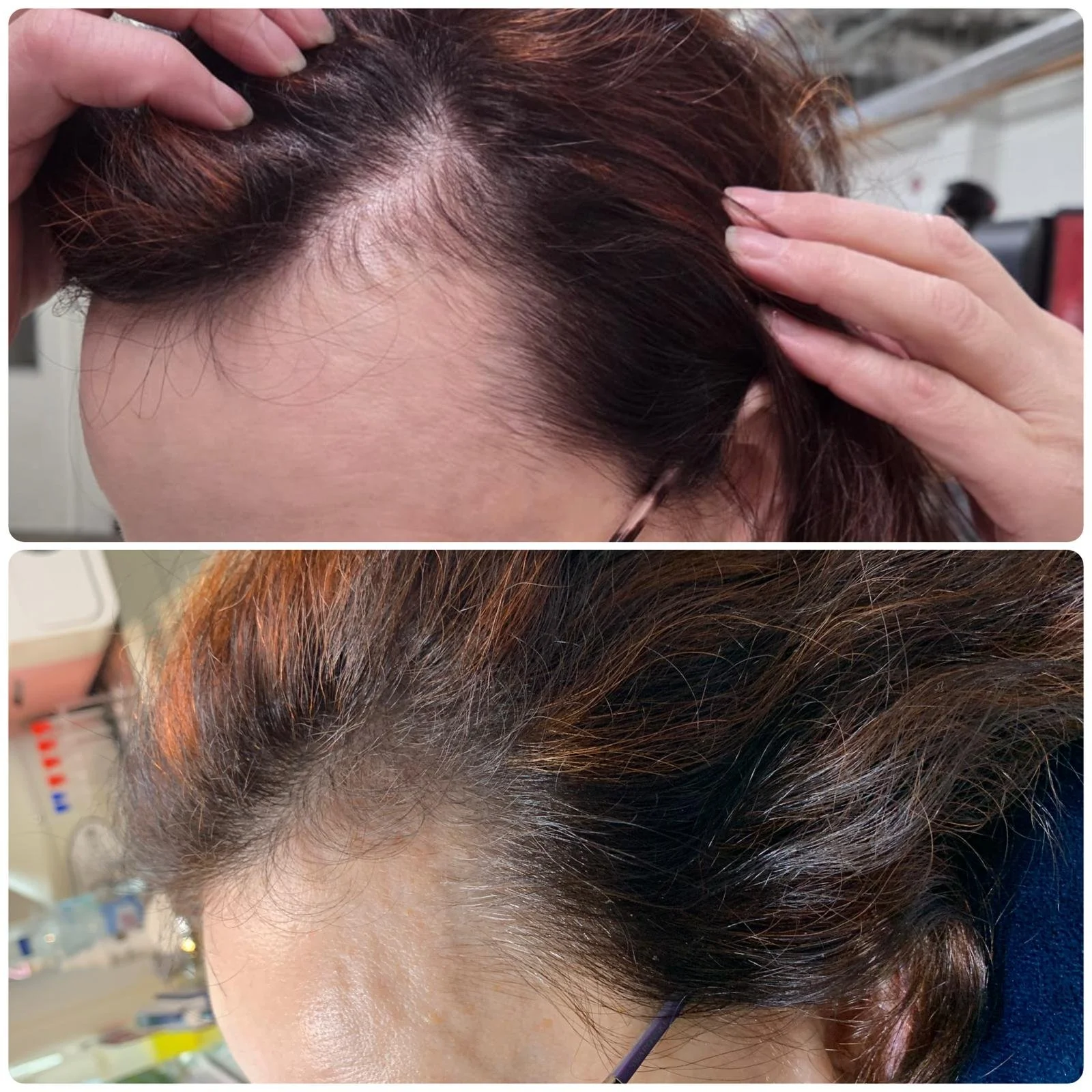 Microneedling Before & After
Results After 6 Sessions