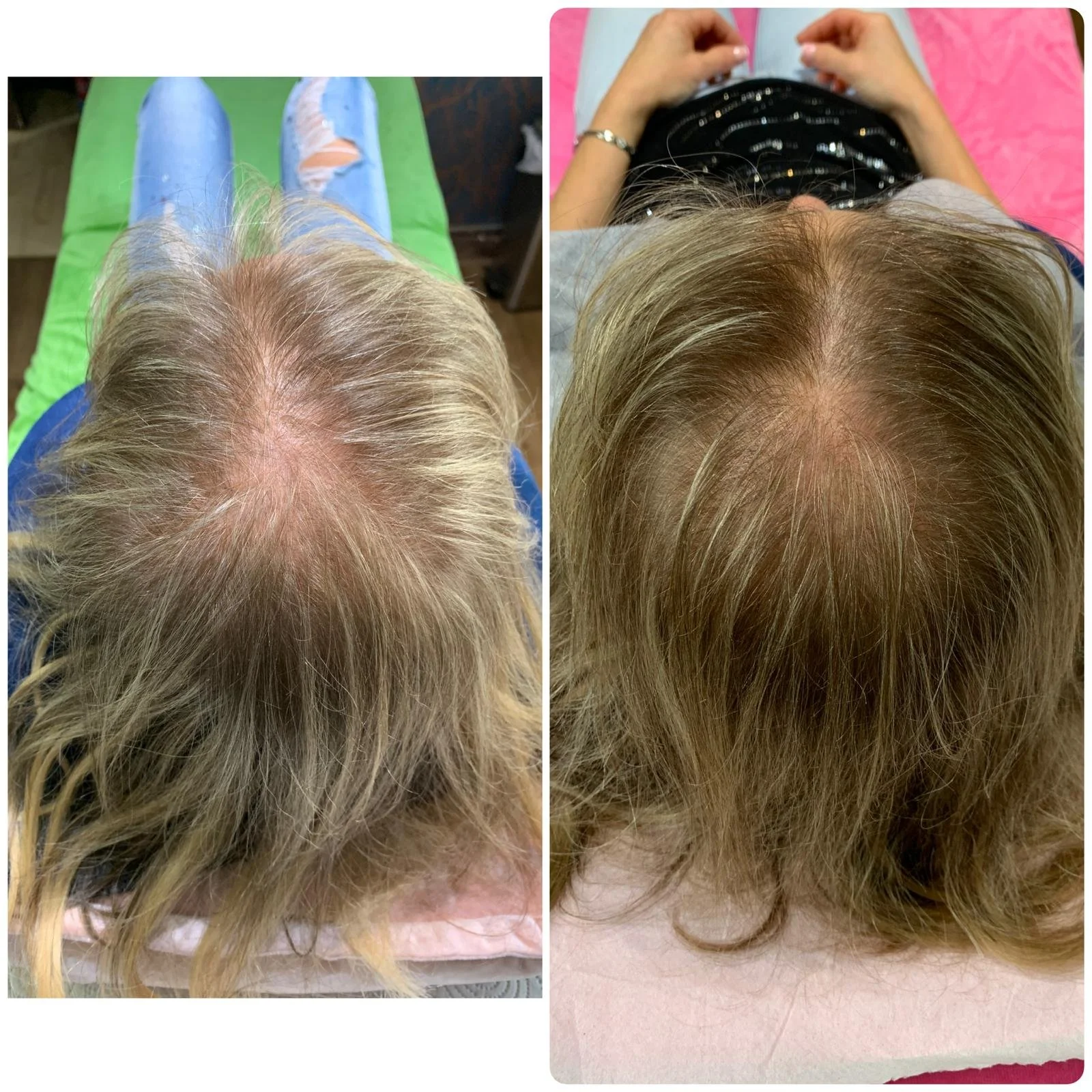 Hair Filler & Microneedling results after 1 month (before) and 3 months (after).
