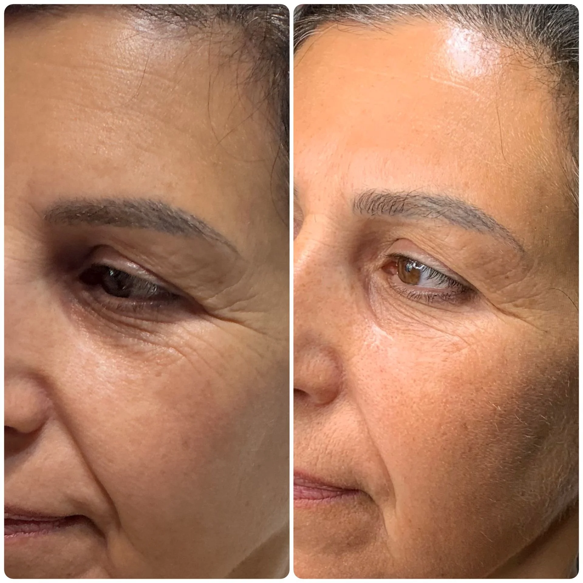 Facial PRP results before and after 2 sessions.