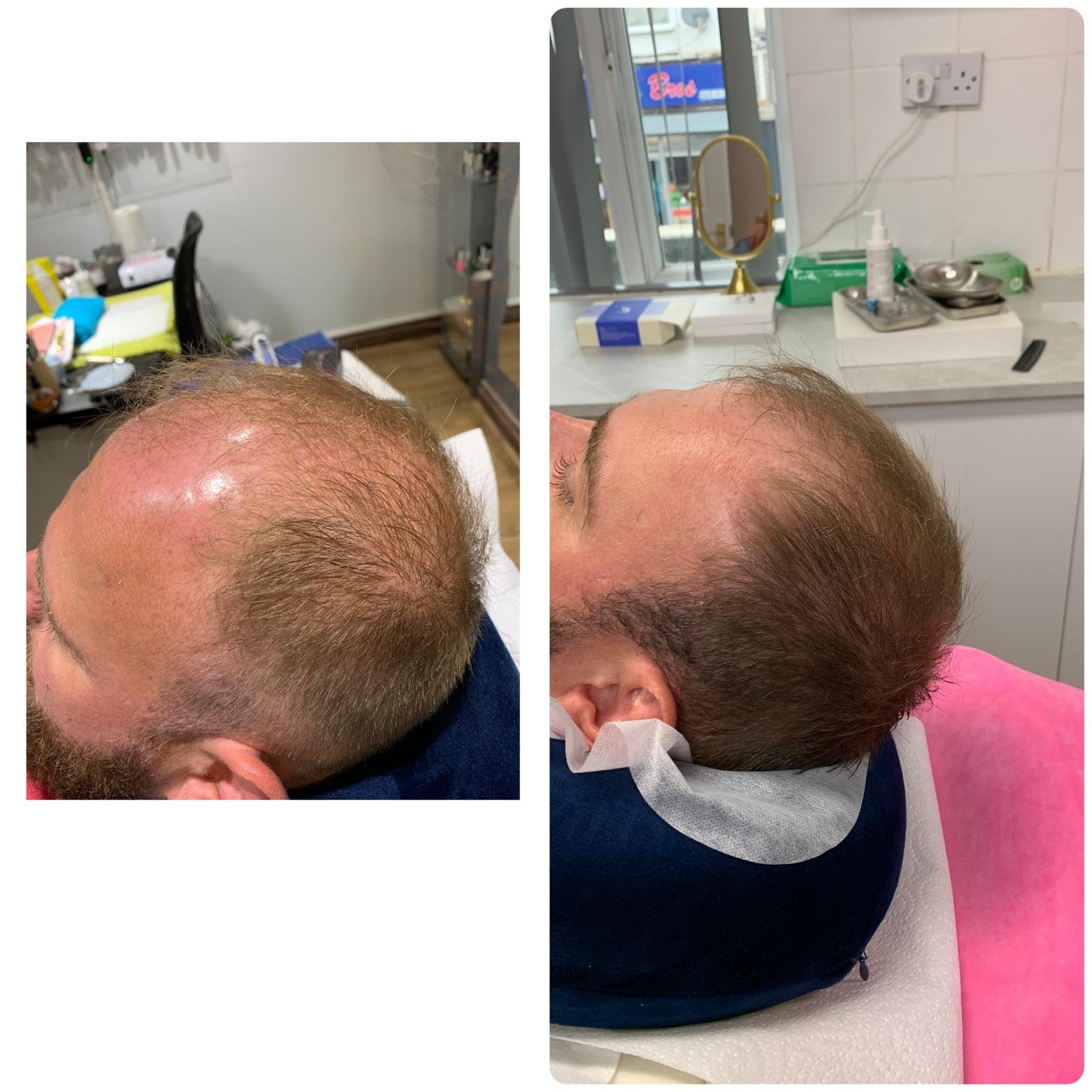 Advanced Hair Filler and microneedling, after 5 treatments
