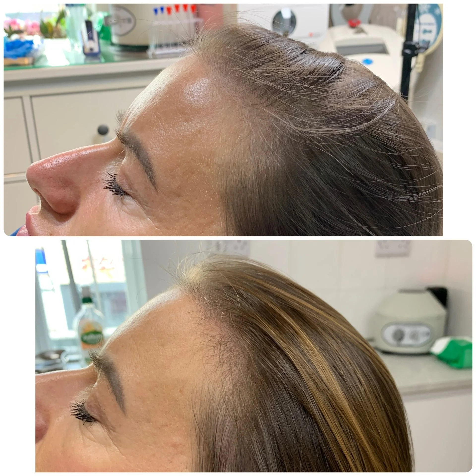 Hair Filler & Microneedling results after 3 sessions.