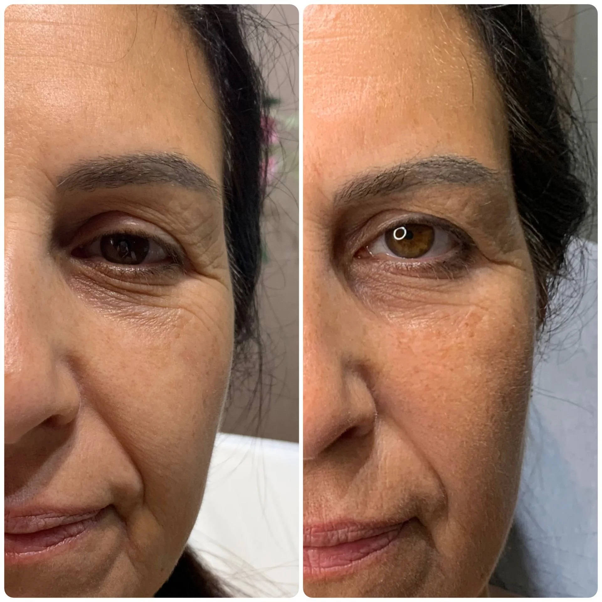 Facial PRP results before and after 2 sessions.