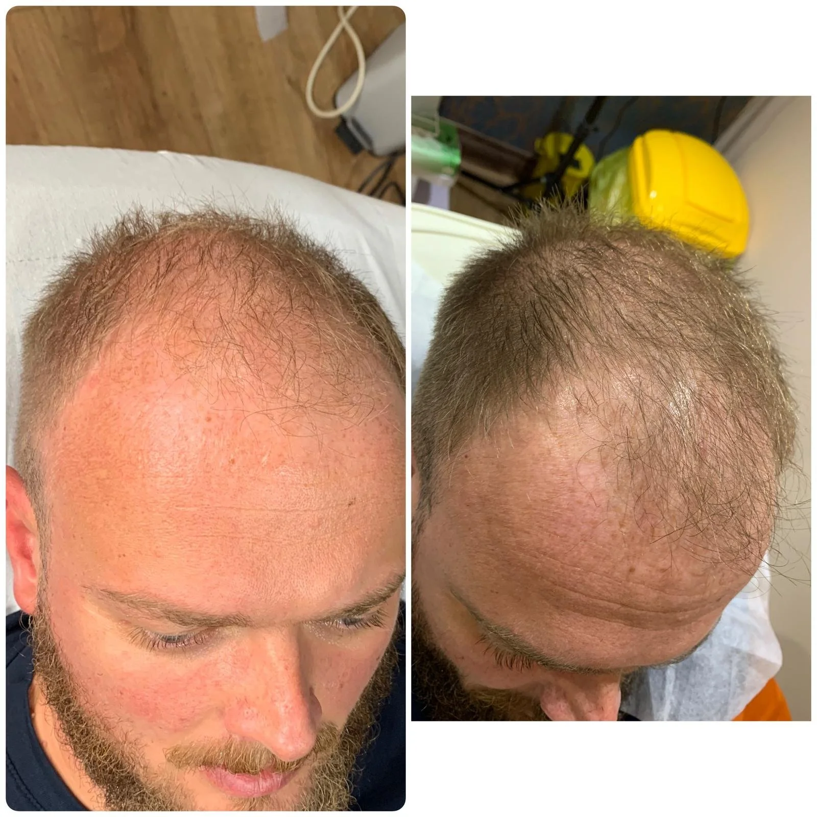 Hair Filler & Microneedling results after 1 month (before) and 3 months (after).