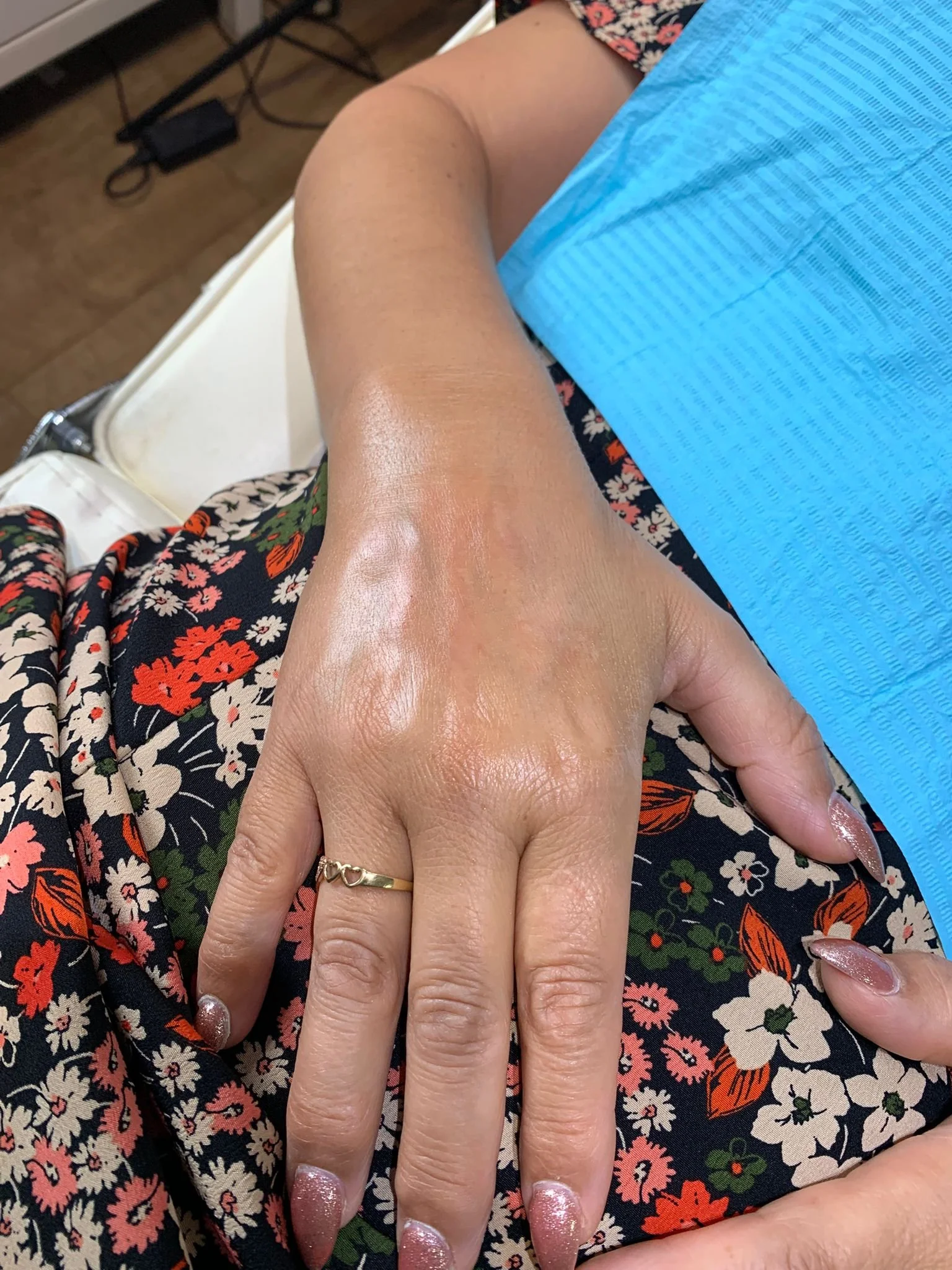Skin PRP results before and after 2 sessions.