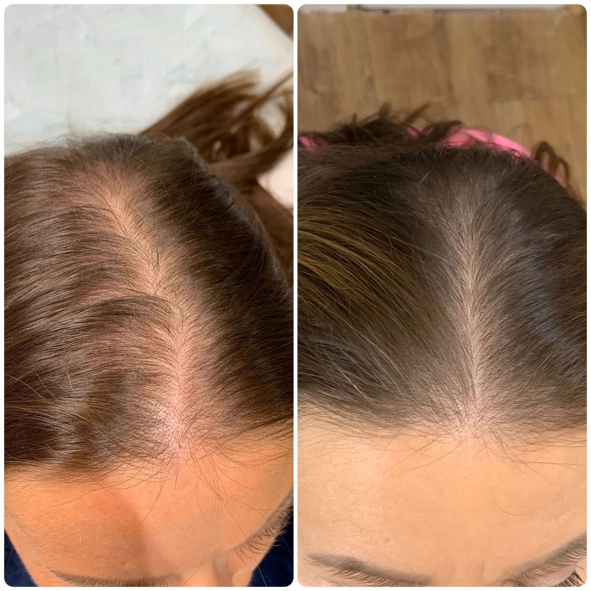 Hair Filler & Microneedling results after 3 sessions.