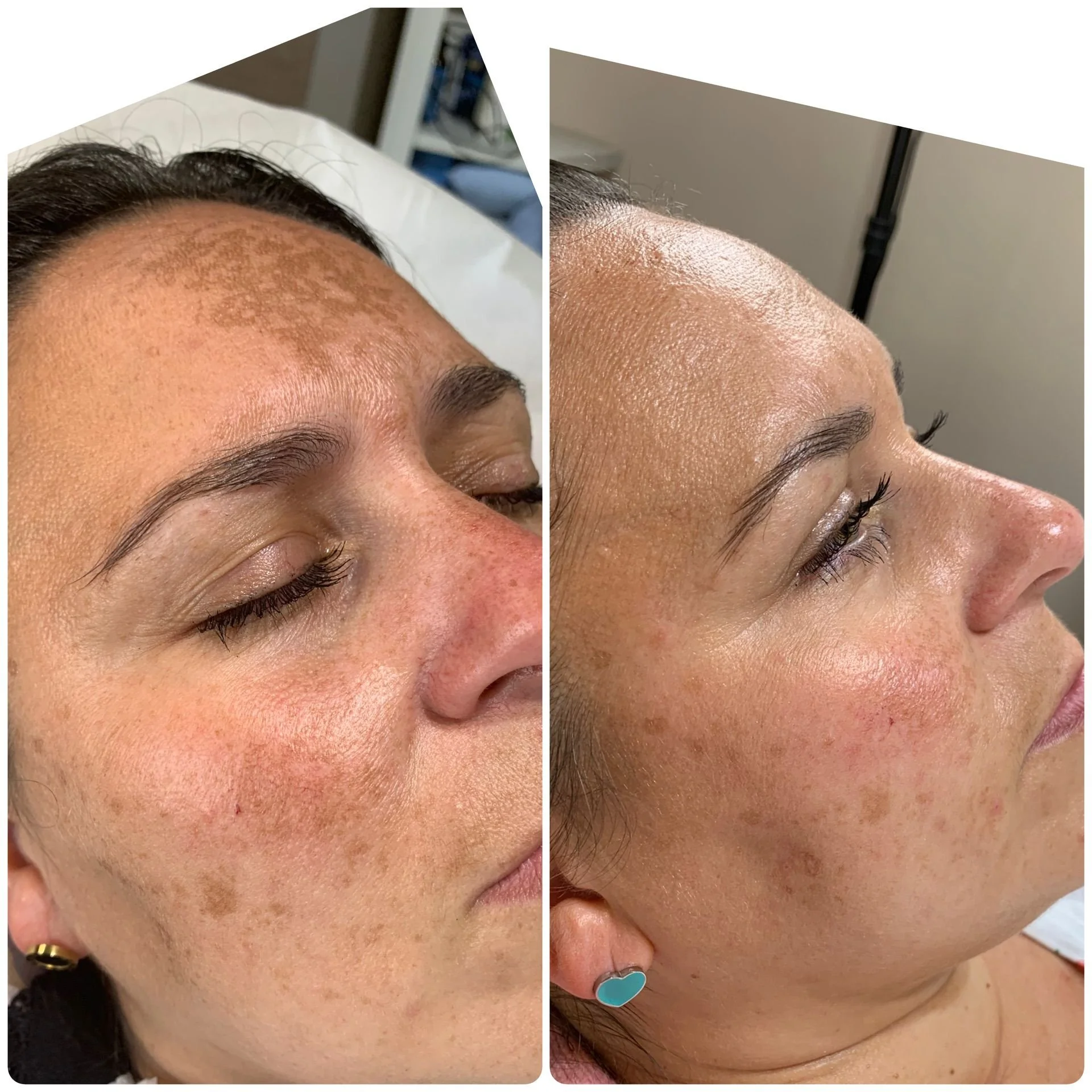 Facial PRP results before and after 2 sessions.