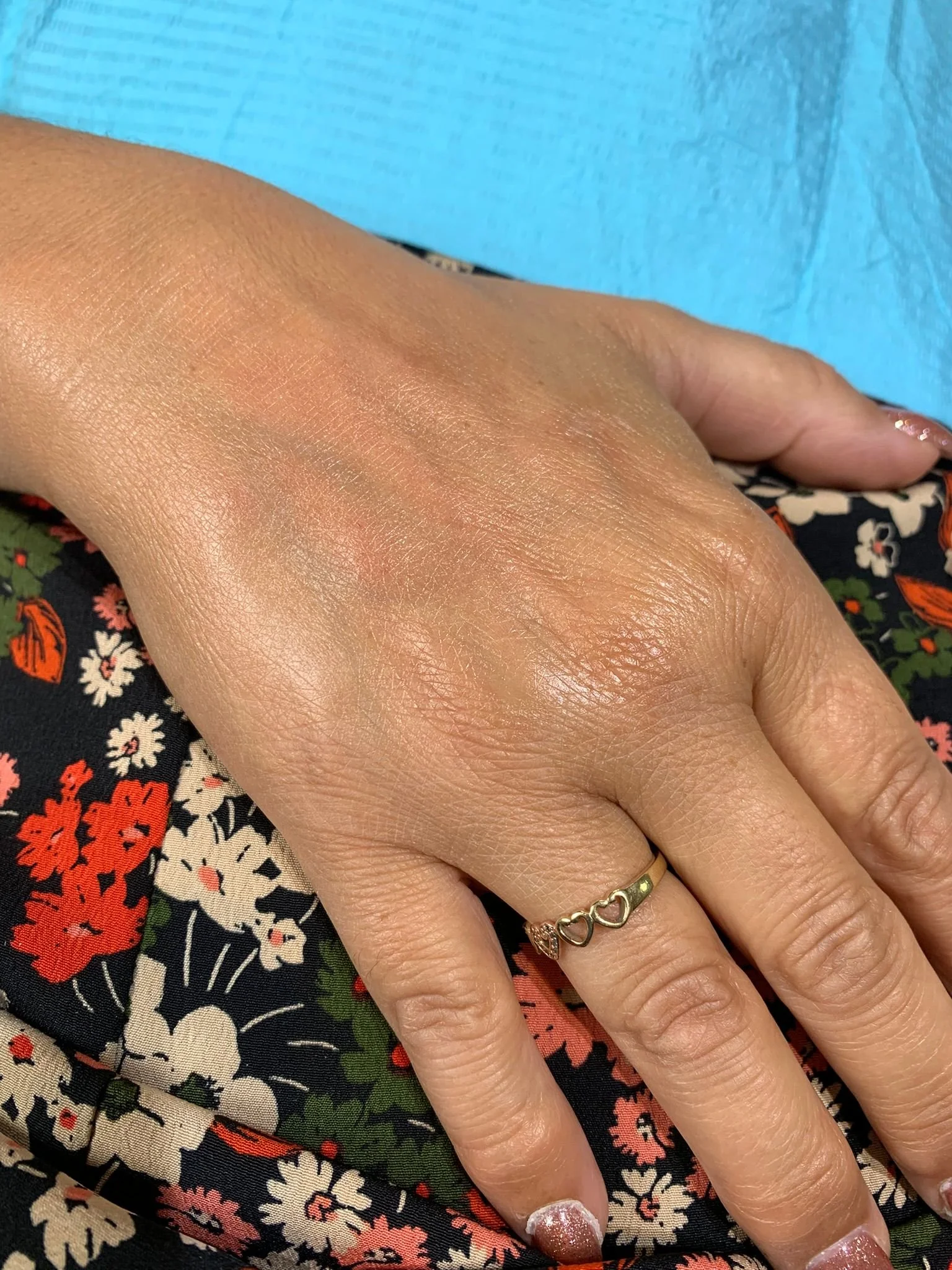 Skin PRP results before and after 2 sessions.