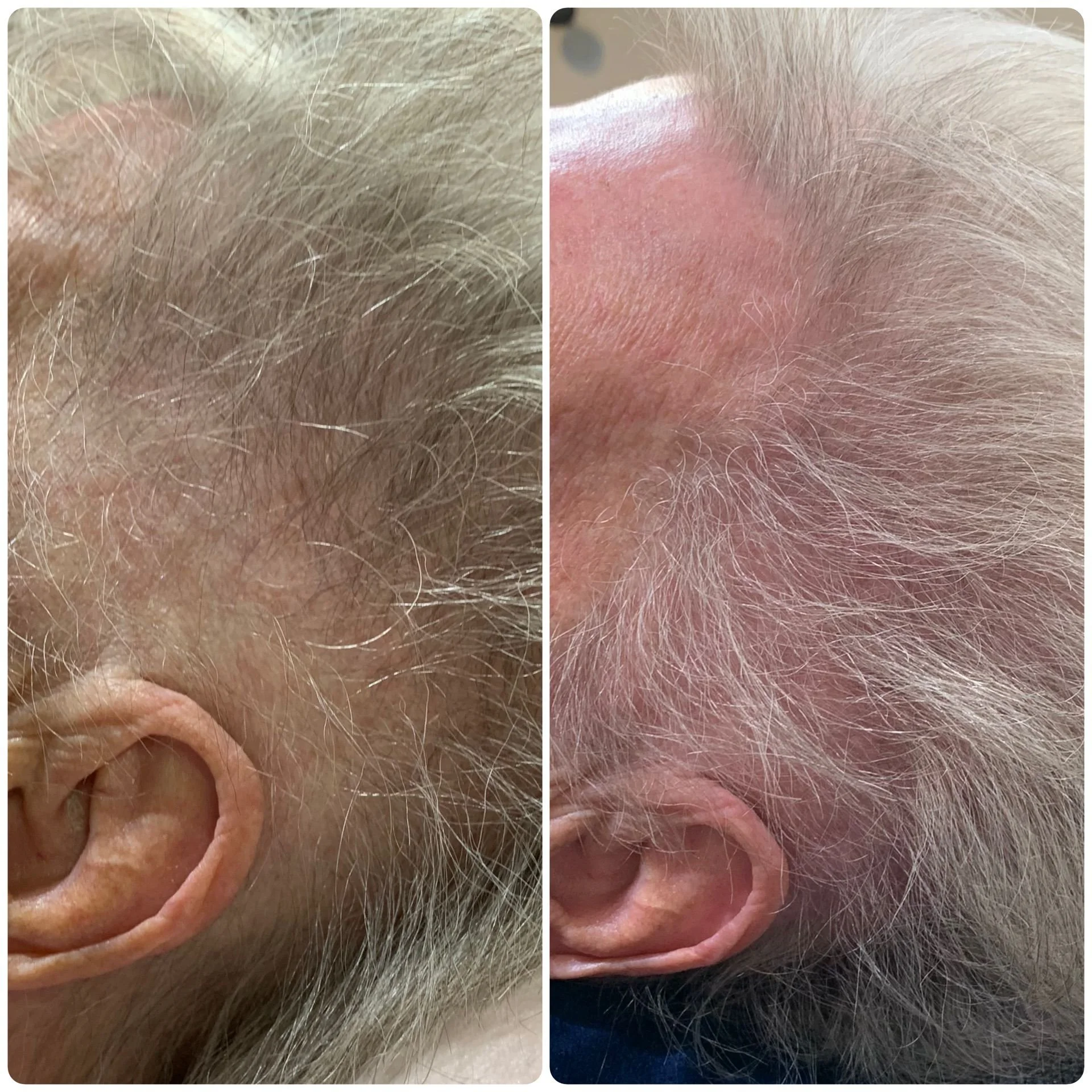 Hair Filler & Microneedling results after 1 month (before) and 3 months (after).