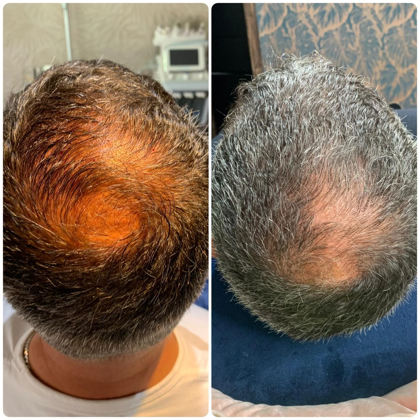 Hair Filler & Microneedling results after 2 sessions.