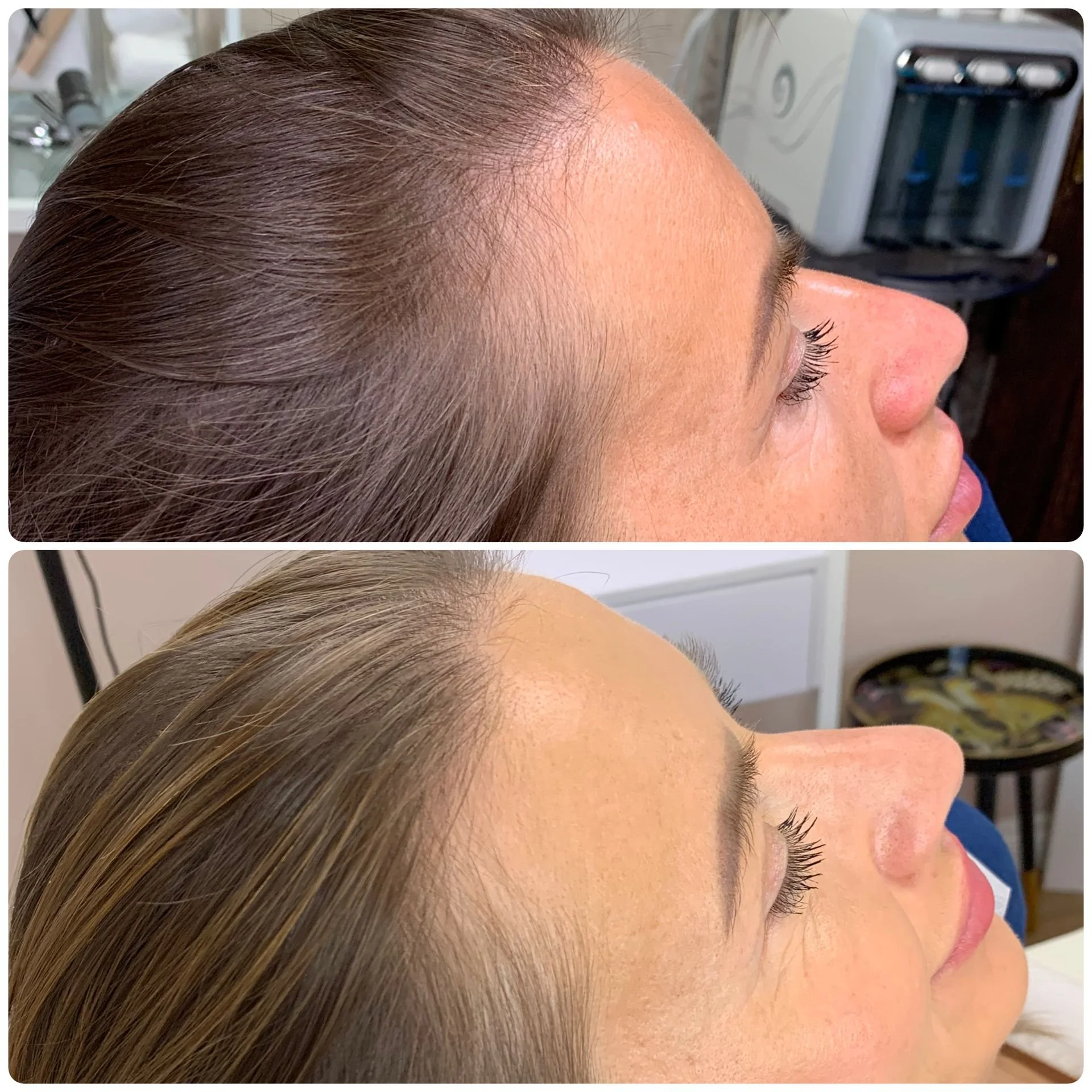 Hair Filler & Microneedling results after 3 sessions.