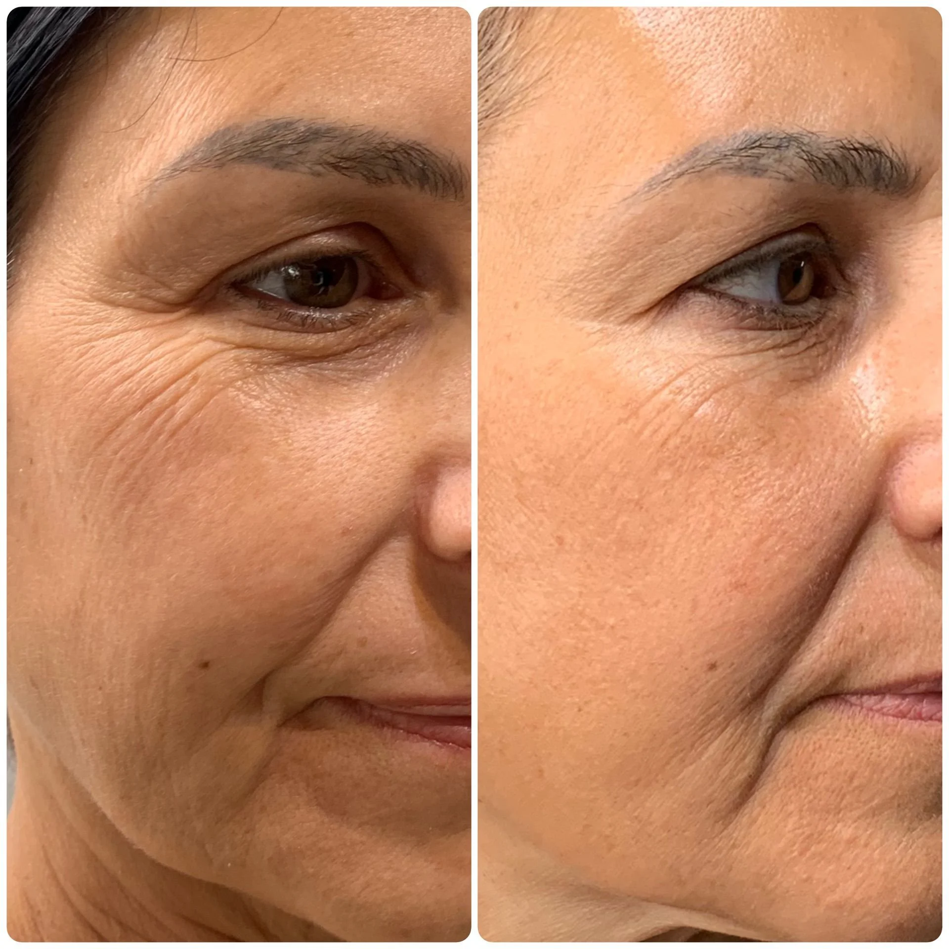 Facial PRP results before and after 2 sessions.