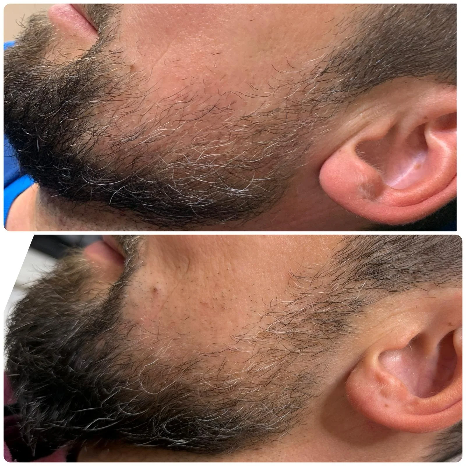 Beard microneedling, after 4 treatments