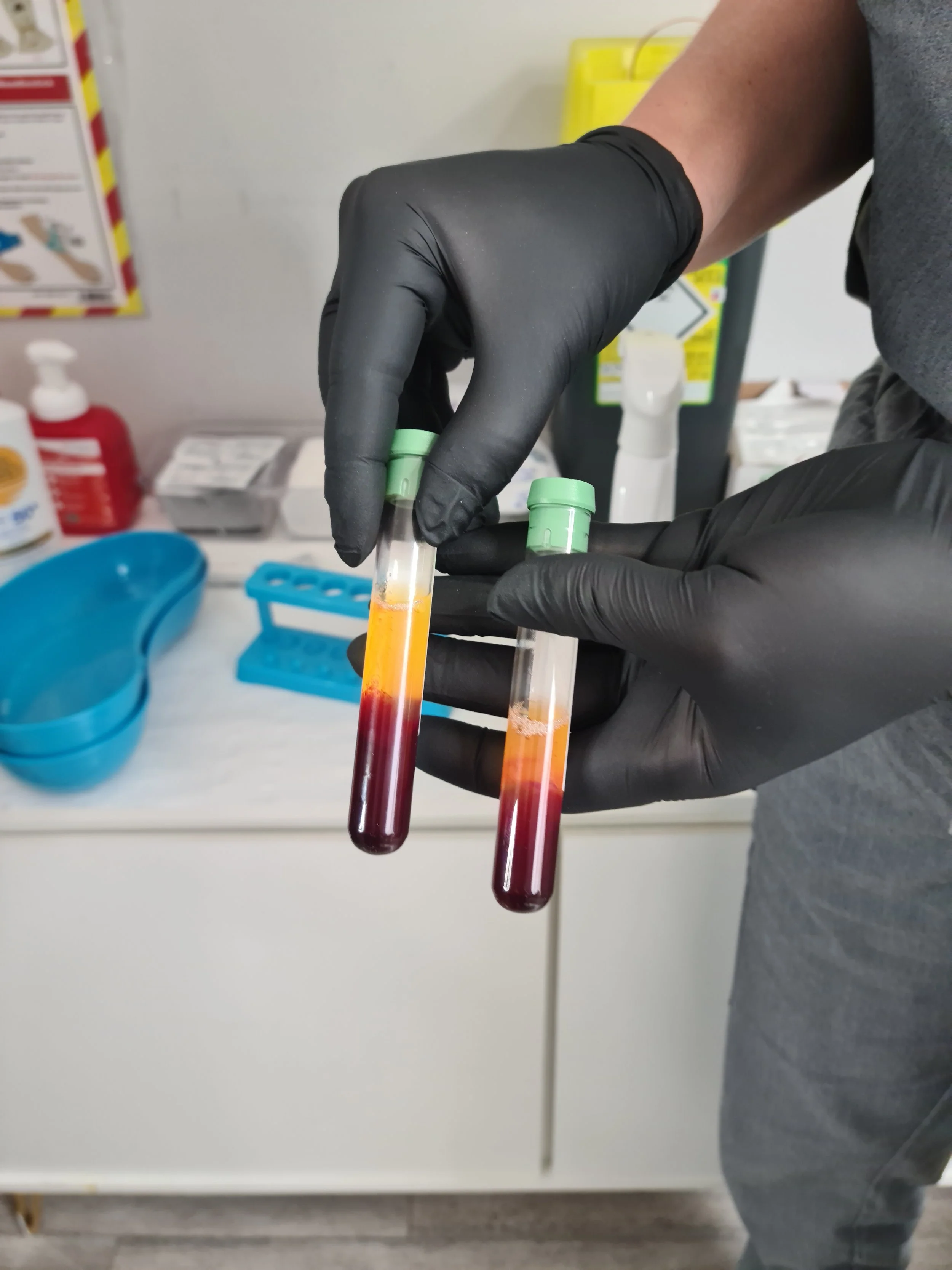 PRP Hair Loss Treatment: Positive Results Backed by Science