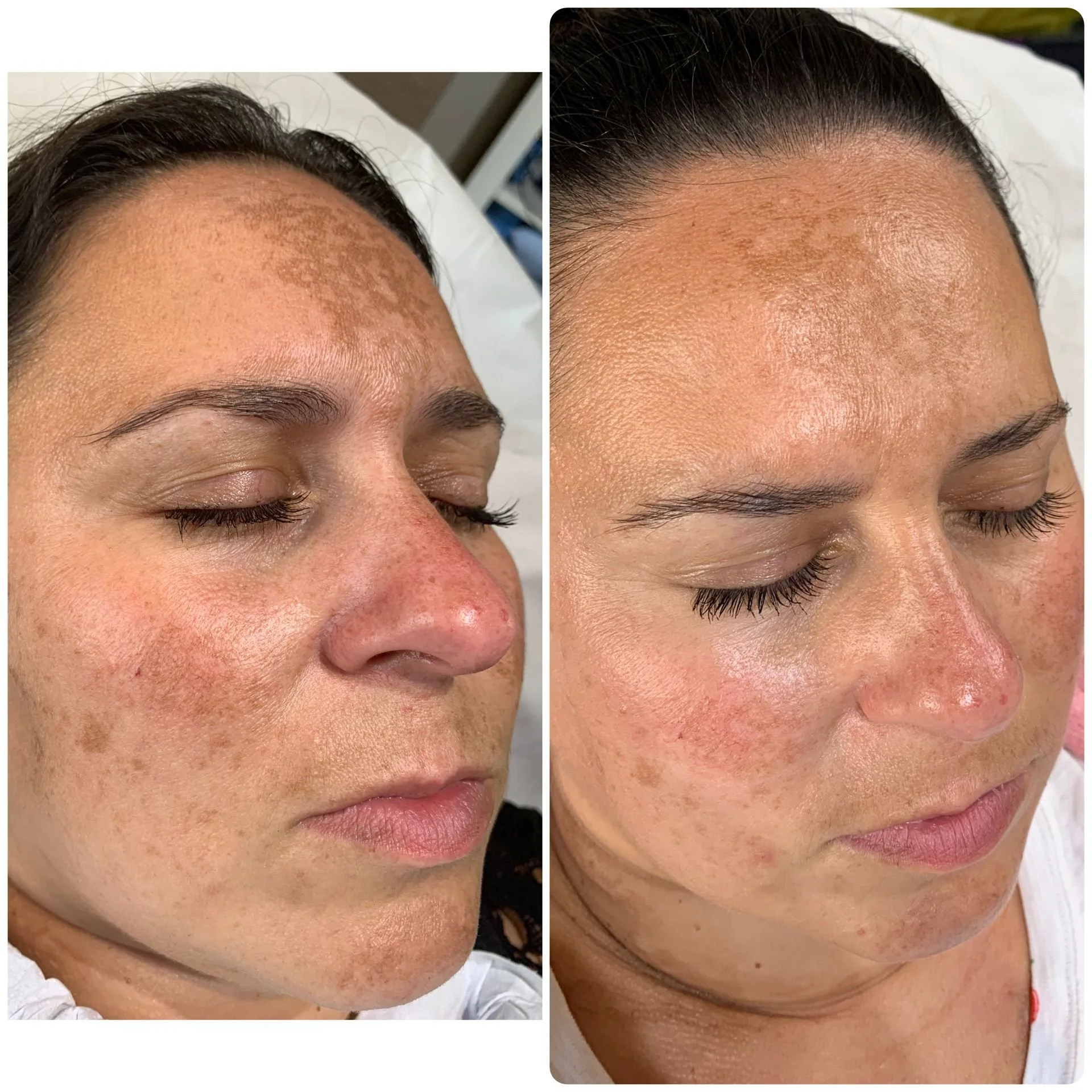 Facial PRP results before and after 2 sessions.