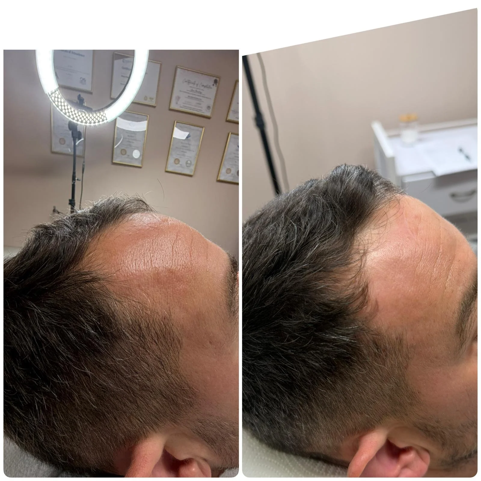 Advanced Hair Filler and microneedling, after 3 treatments