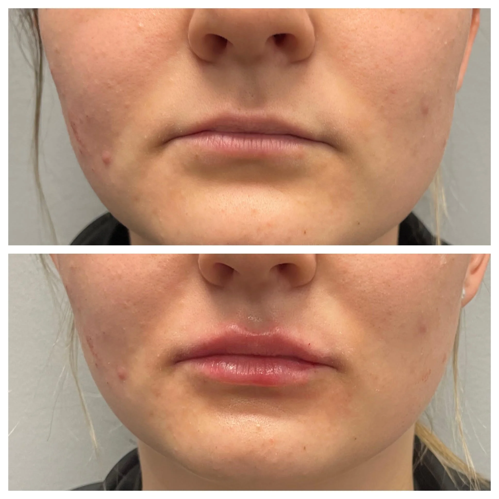 Results Achieved Using 1 Syringe of Restylane L