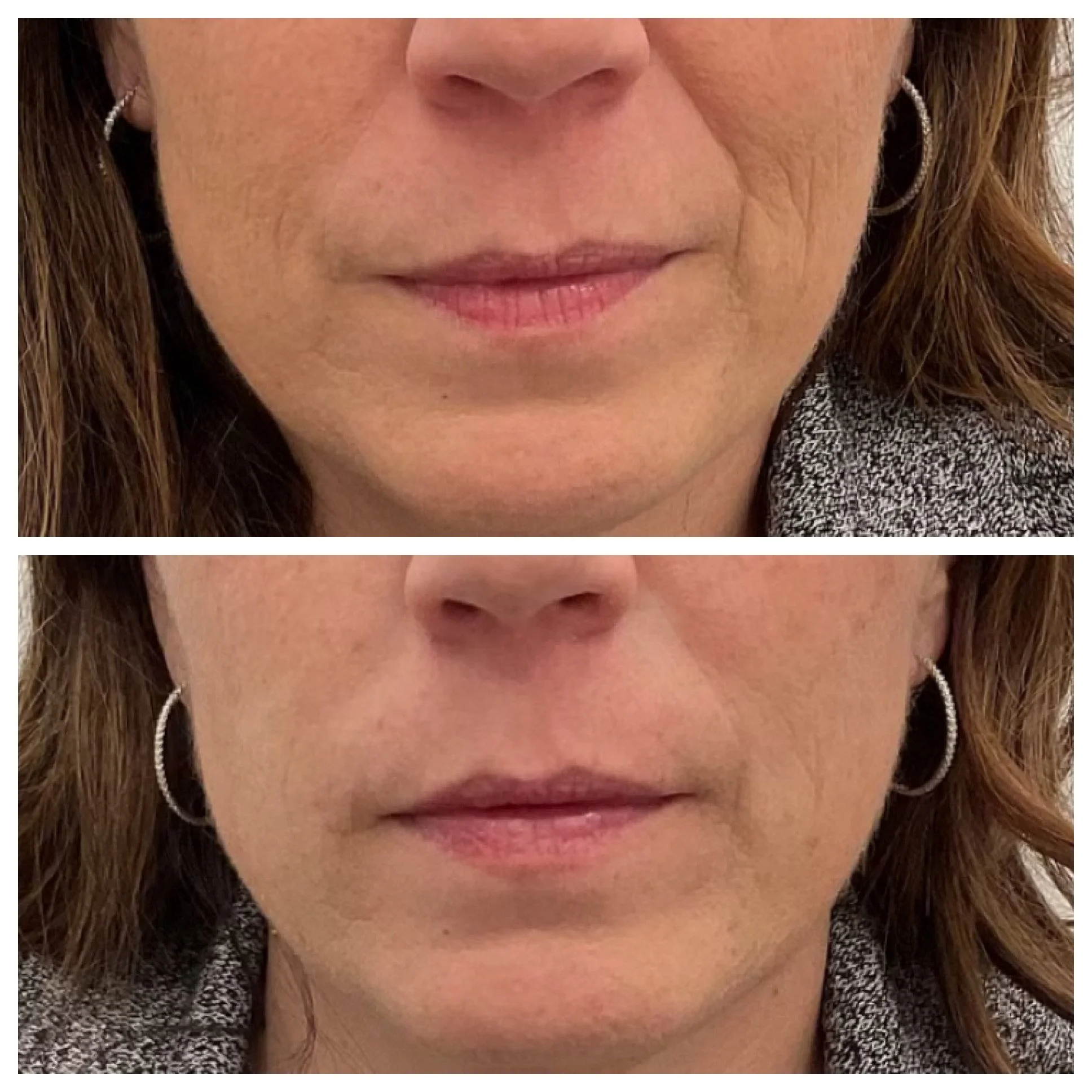 Results Achieved Using 2 Syringes of Juvederm Vollure
