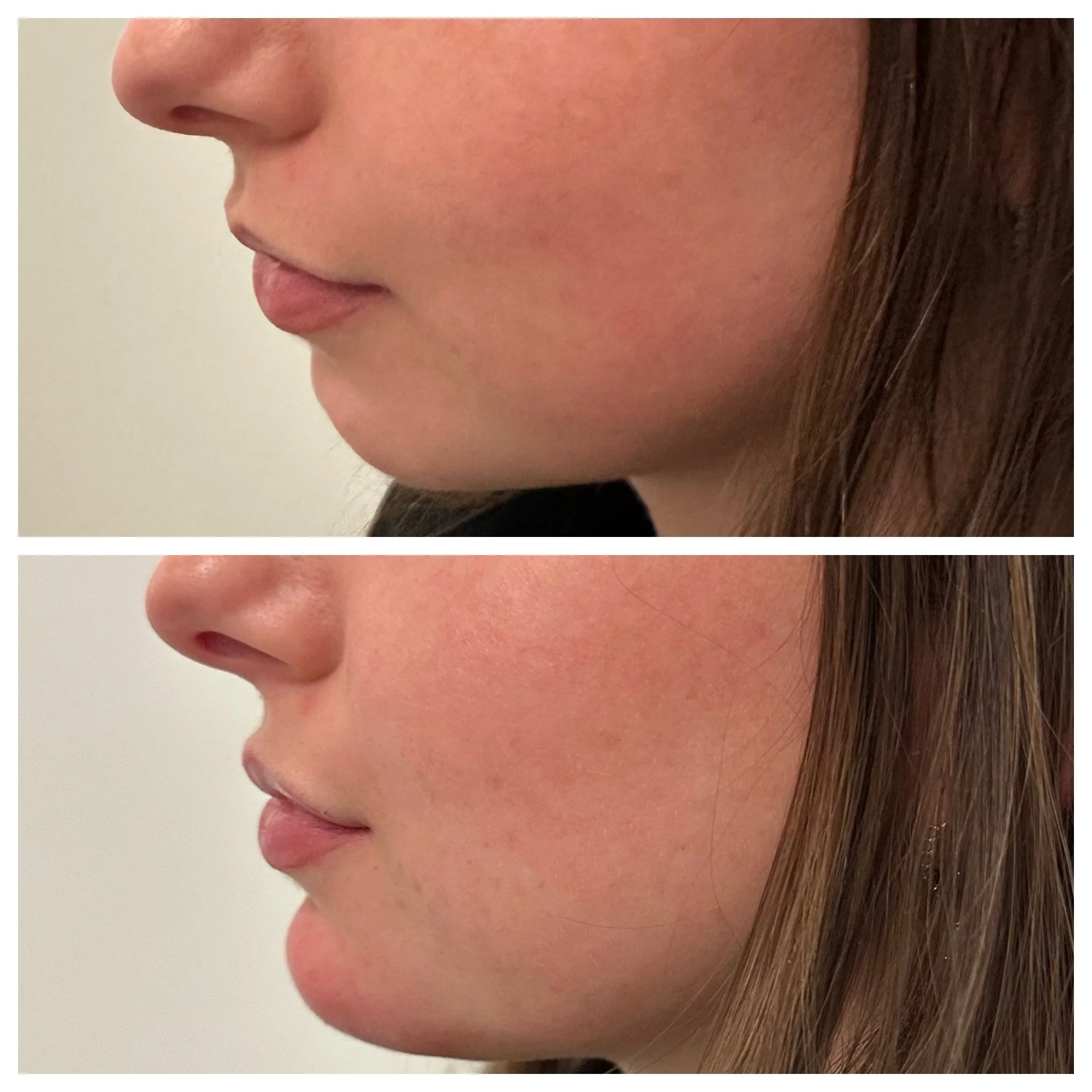 Results Achieved Using 2 Syringes of Juvederm Voluma