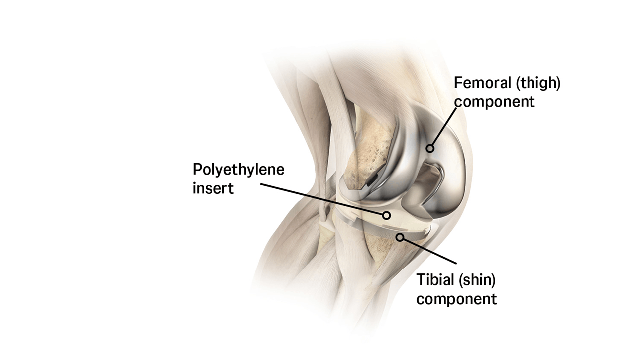 Labeled illustration of a total knee implant