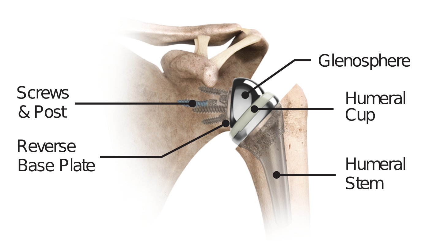 Labeled reverse total shoulder implant