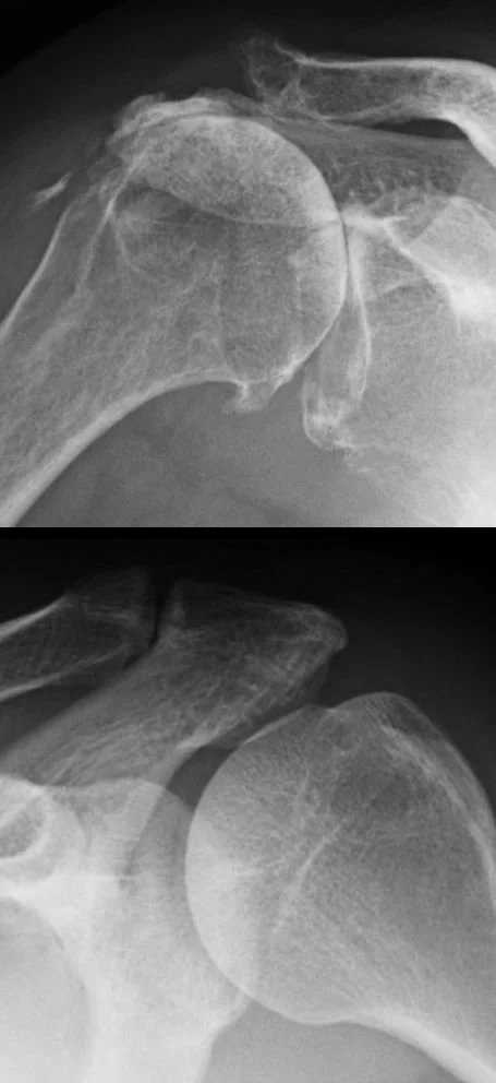 X-ray of shoulder osteoarthritis