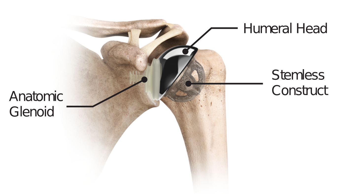 Labeled anatomic total shoulder implant