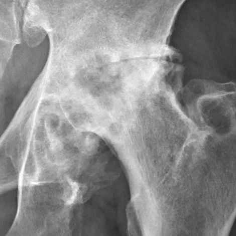 X-ray of severe osteoarthritis of the hip