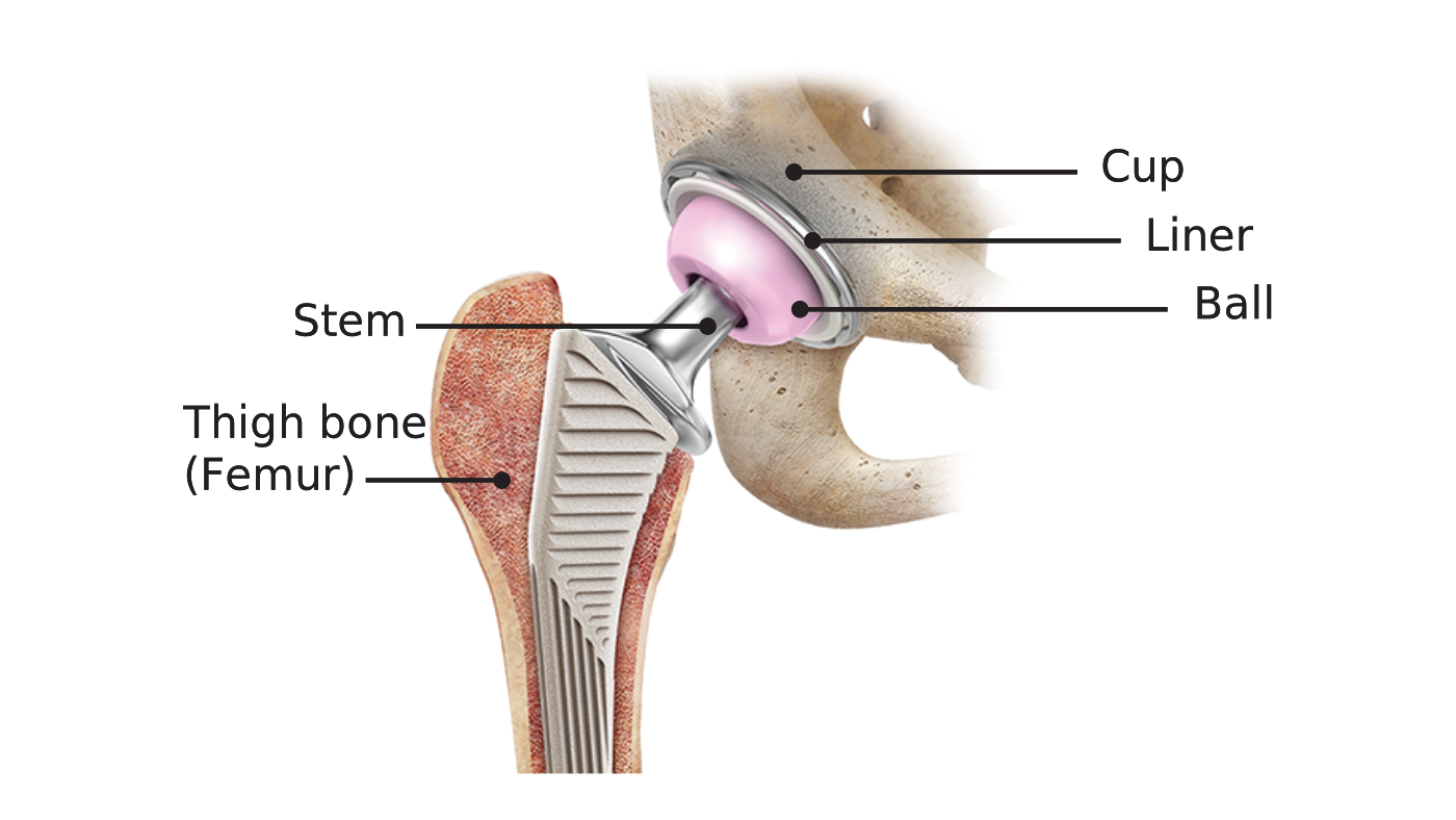 Labeled illustration of a total hip implant