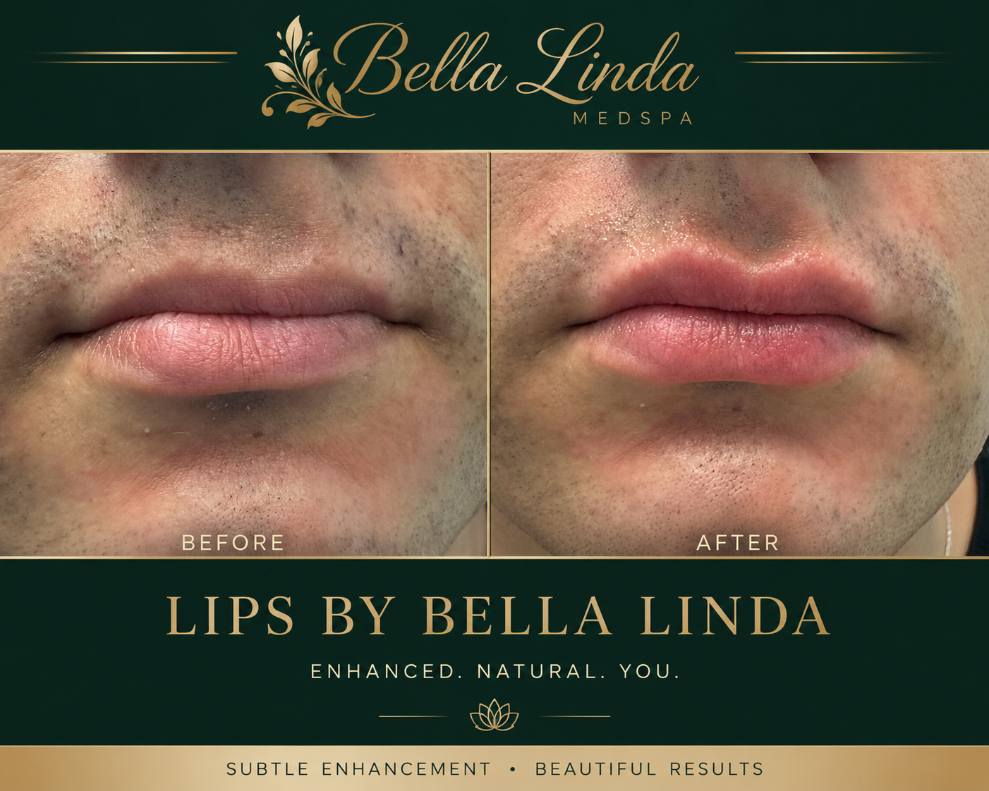 Side-by-side comparison of lips before and after a treatment at Bella Linda MedSpa. The left side shows lips with more skin imperfections, while the right side shows smoother, more enhanced lips. The image features text indicating "Before" and "After" above each respective set of lips.