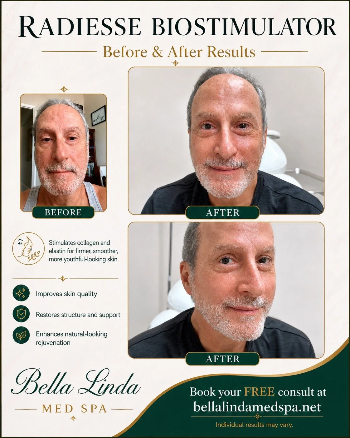 Advertisement for Radiesse Biostimulator showing a before and after comparison of an older man with a beard. The 'before' photo shows him with sagging skin, while the 'after' photo shows more youthful and firm skin. The ad highlights benefits like improved skin quality, restored support, and natural-looking rejuvenation, and offers free consultations at Bella Linda Med Spa.