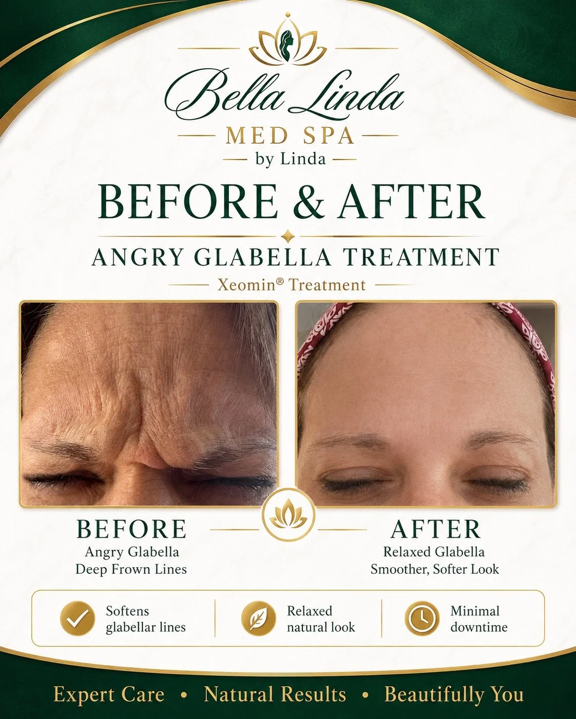 Before and after images of a forehead showing a treatment for angry glabella with deep frown lines. The 'before' image shows prominent wrinkles, while the 'after' image shows a smoother, relaxed appearance with fewer lines. The text highlights the treatment's effects, including softening glabellar lines, a natural look, and minimal downtime.