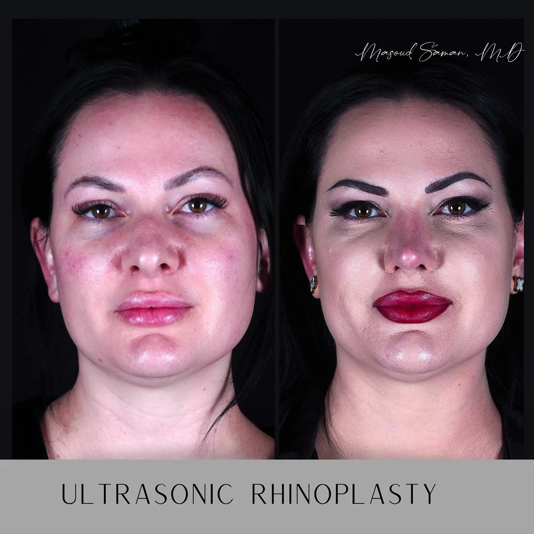 Long term results matter. #rhinoplastynyc #ultrasonicrhinoplasty 

Masoud Saman, MD is a double board-certified facial plastic surgeon based in New York City. His boutique practice is dedicated exclusively to advanced procedures of the face and neck,