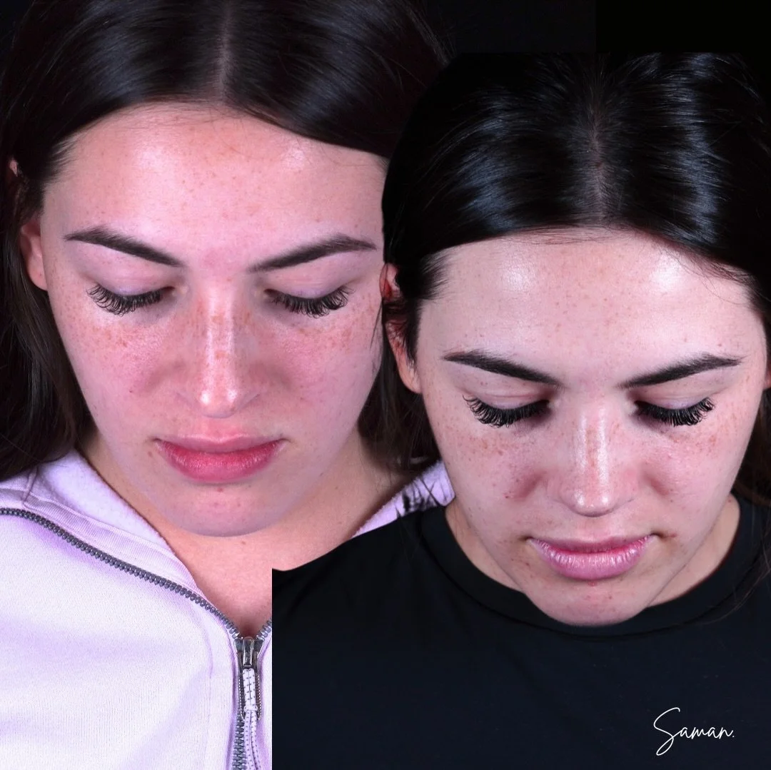 Ultrasonic primary rhinoplasty- 1 year postop. For your viewing pleasure.

Masoud Saman, MD is a double board-certified facial plastic surgeon based in New York City. His boutique practice is dedicated exclusively to advanced procedures of the face a