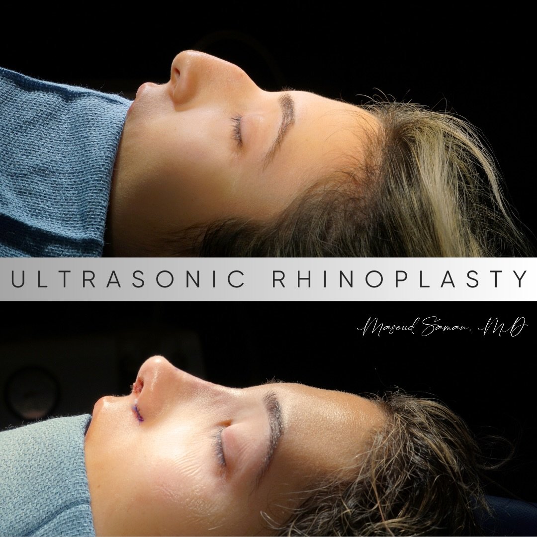 Ten years of hiding her side profile, and difficulty breathing. 
Tons of fear, doubt and research&hellip; and finally here she is, immediately after her surgery!
 
Thank you for trusting me and for allowing me to share your transformation. Couldn&rsq