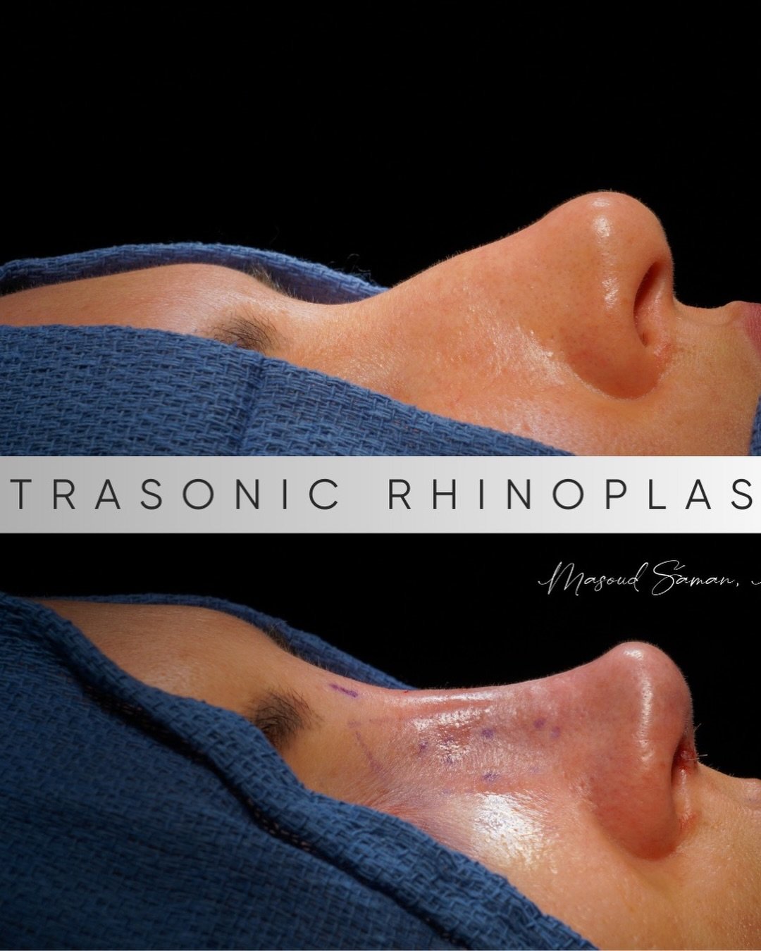 Boom. #rhinoplasty