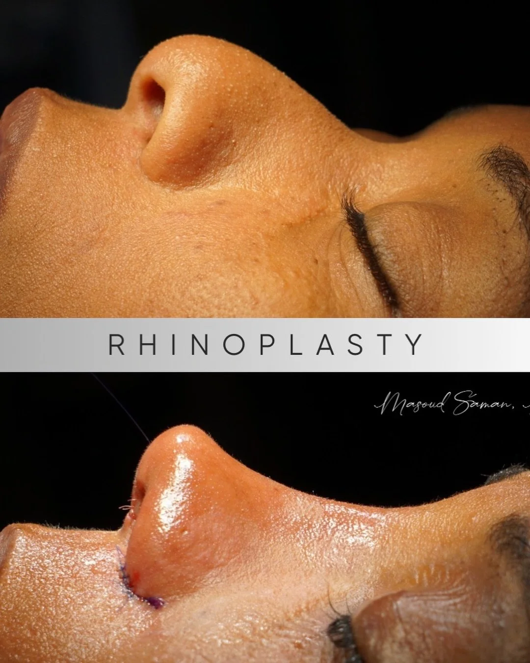 &ldquo;Ethnic rhinoplasty&rdquo; is a lazy label.
I prefer thick-skin, low-bridge rhinoplasty. Descriptive and anatomic, not a category.

And no, it&rsquo;s not the same technique.
This type of rhinoplasty requires a very different skill set. 😁