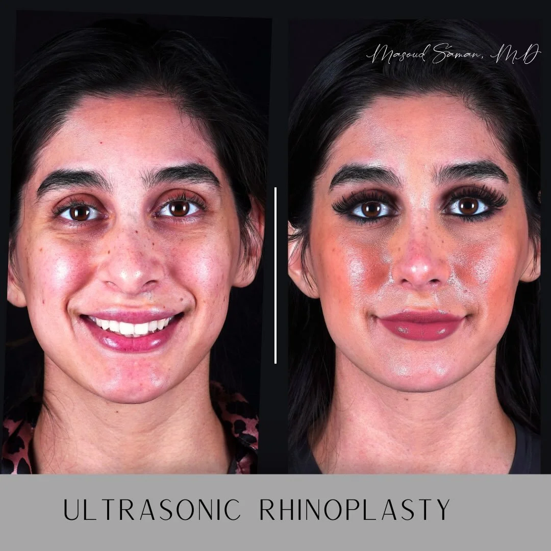Ultrasonic rhinoplasty, long term outcomes. 

Masoud Saman, MD is a double board-certified facial plastic surgeon based in New York City. His boutique practice is dedicated exclusively to advanced procedures of the face and neck, including rhinoplast