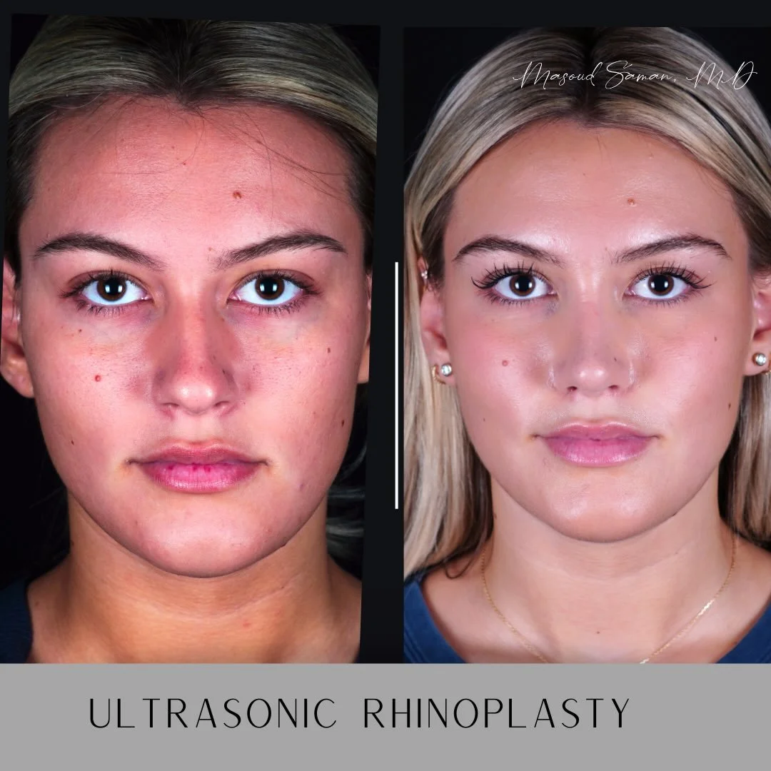 Already beautiful, just a little refinement.

This lovely patient of mine, Emira D&rsquo;Spain @xoxoemira , underwent a quaternary rhinoplasty (complex revision rhinoplasty) over a year ago after having had 3 previous unsuccessful rhinoplasties. Her 