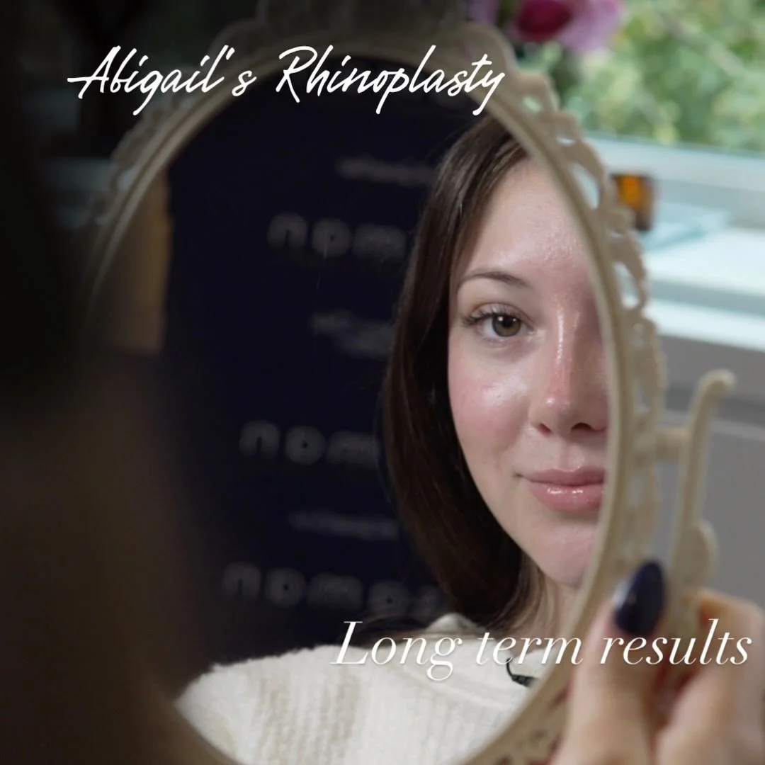 Intelligence, grit, and grace. 🤍

Many of you met Abigail during her internship with us. She was the first to arrive and the last to leave, displaying a rare kind of dedication while assisting in the OR and learning the nuances of #rhinoplasty.

Aft