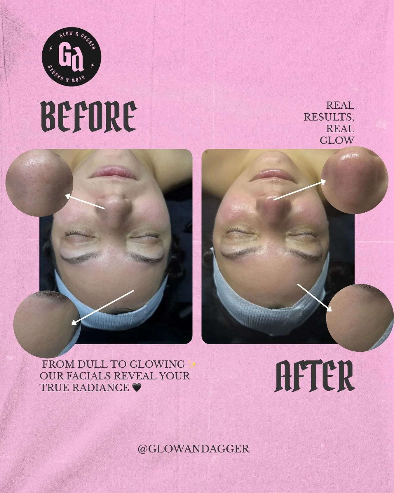 ✨ Real results. Real glow. ✨

When your skin goes from tired + dull ➝ fresh + radiant 🖤🤩

At Glow &amp; Dagger, facials aren&rsquo;t cookie cutter. Every treatment is tailored to your skin&rsquo;s needs so you leave with more than just a glow, you 